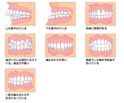 歯 正しい 噛み 合わせ