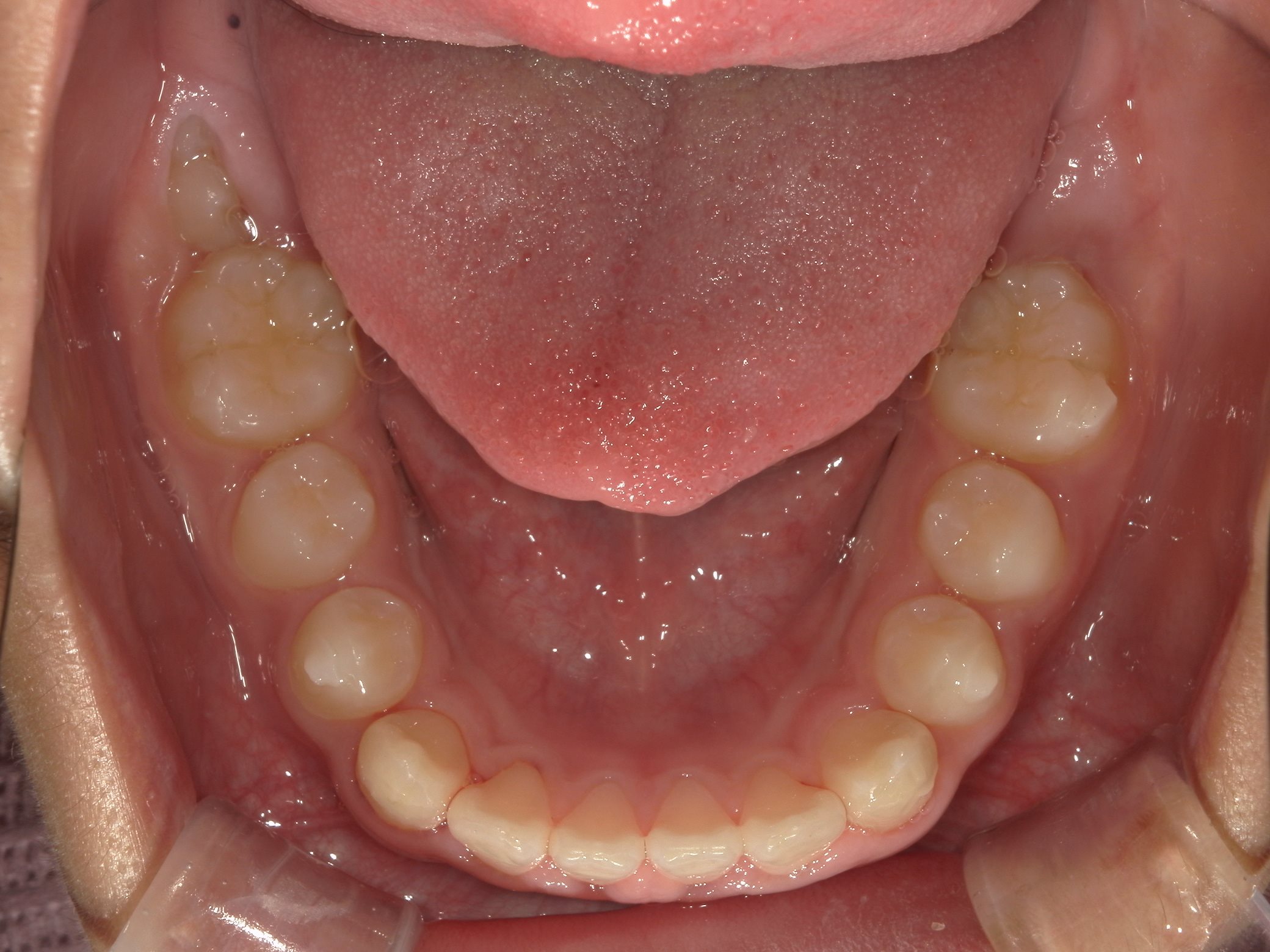 インビザラインファースト