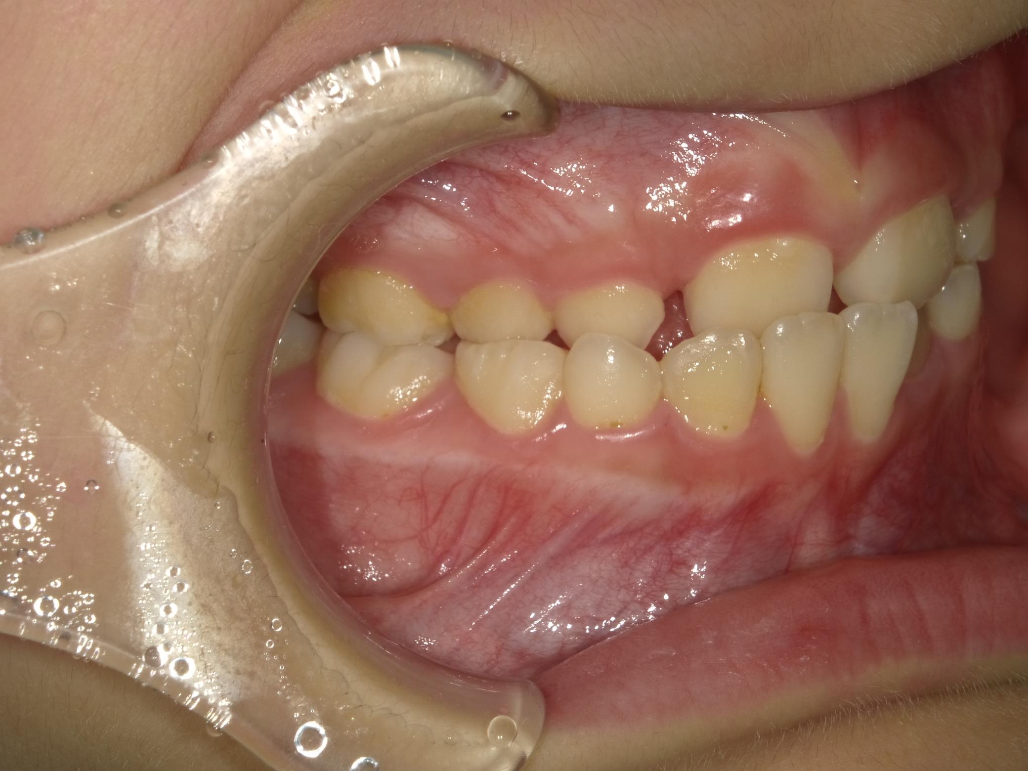 インビザラインファースト