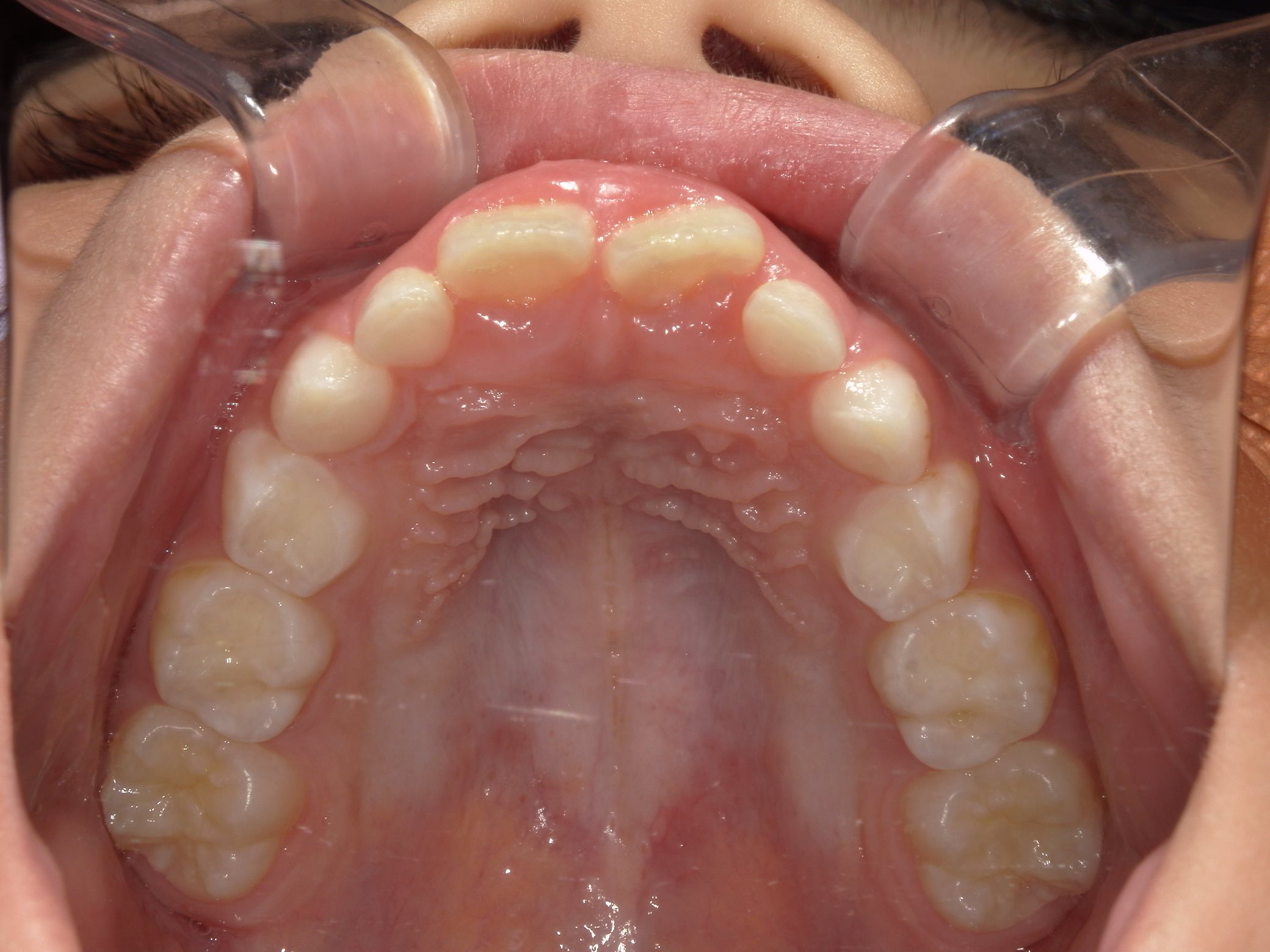 インビザラインファースト