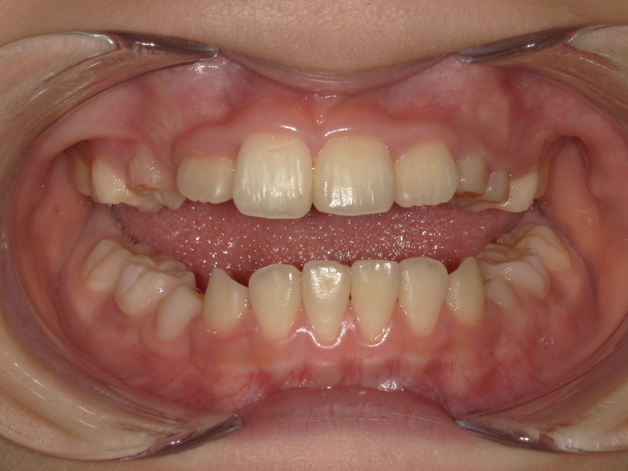 インビザラインファースト