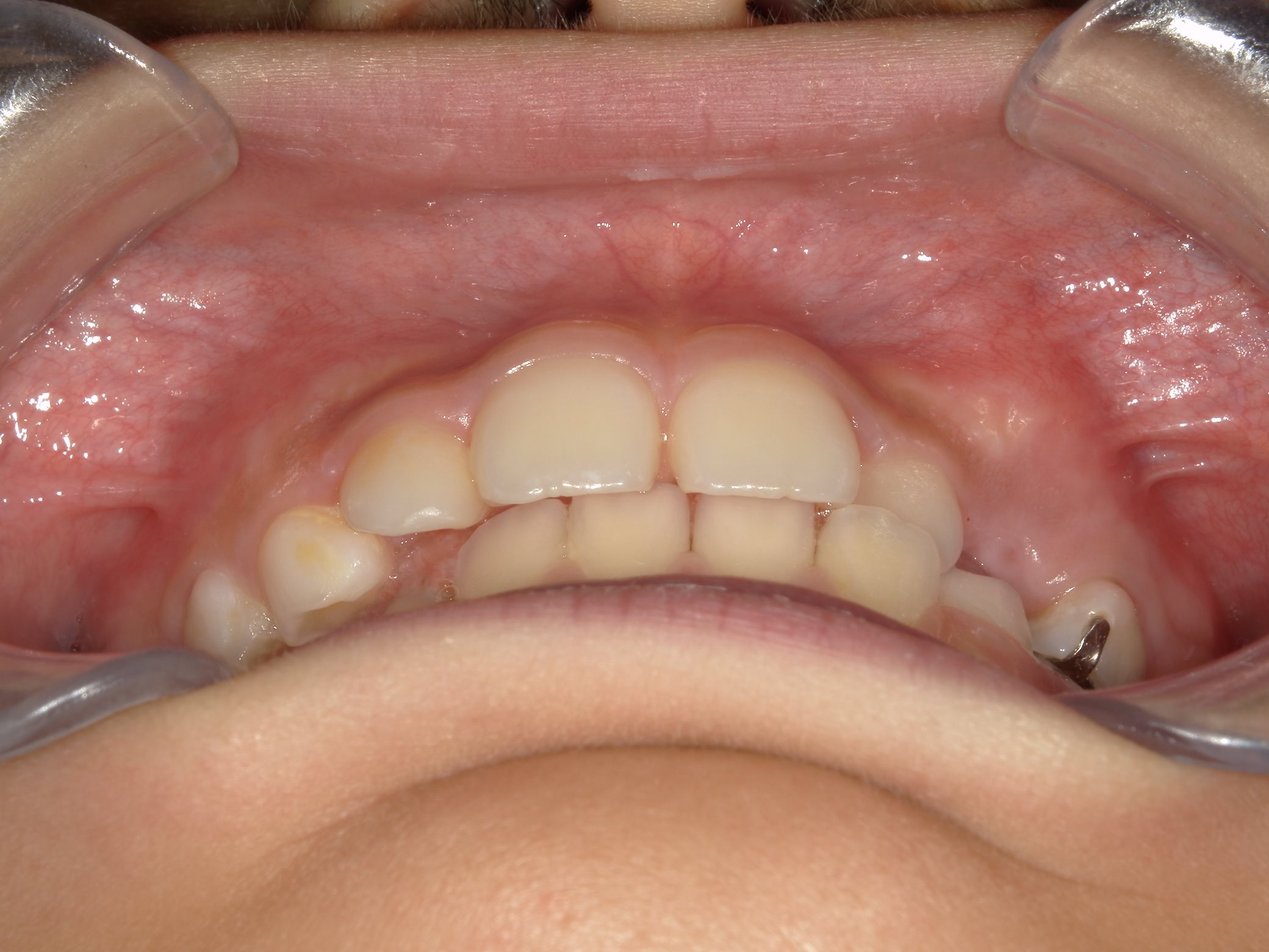 インビザラインファースト