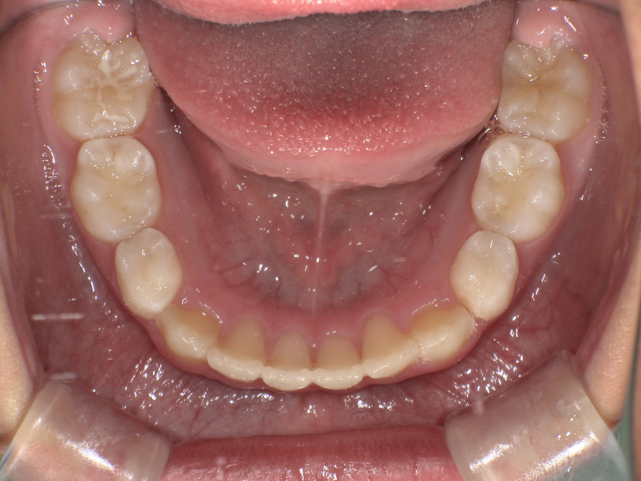 インビザラインファースト