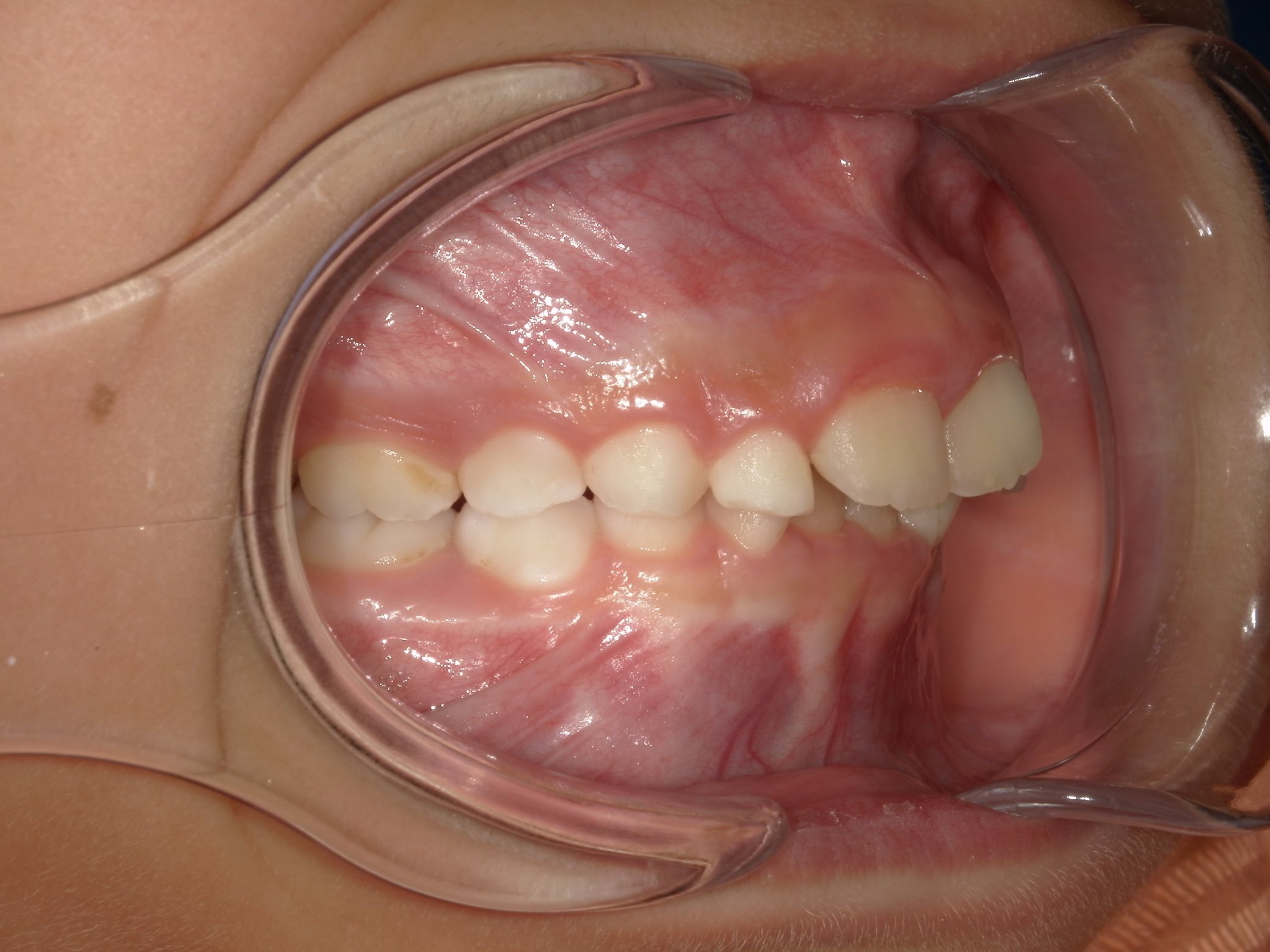 インビザラインファースト