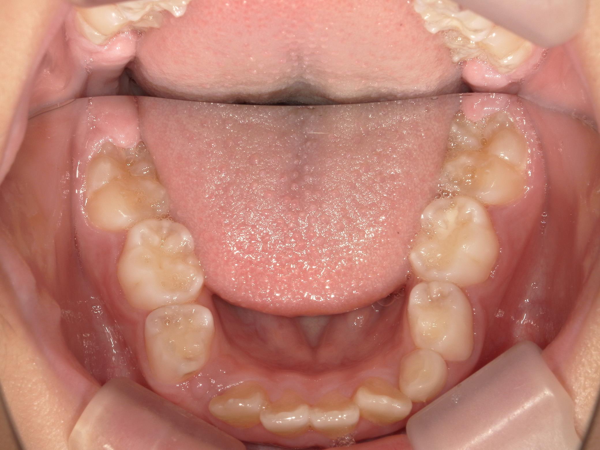 インビザラインファースト