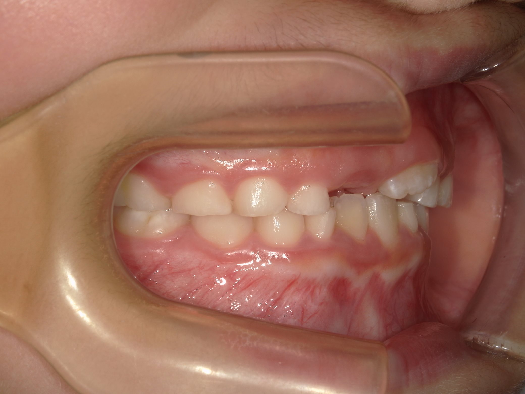 インビザラインファースト