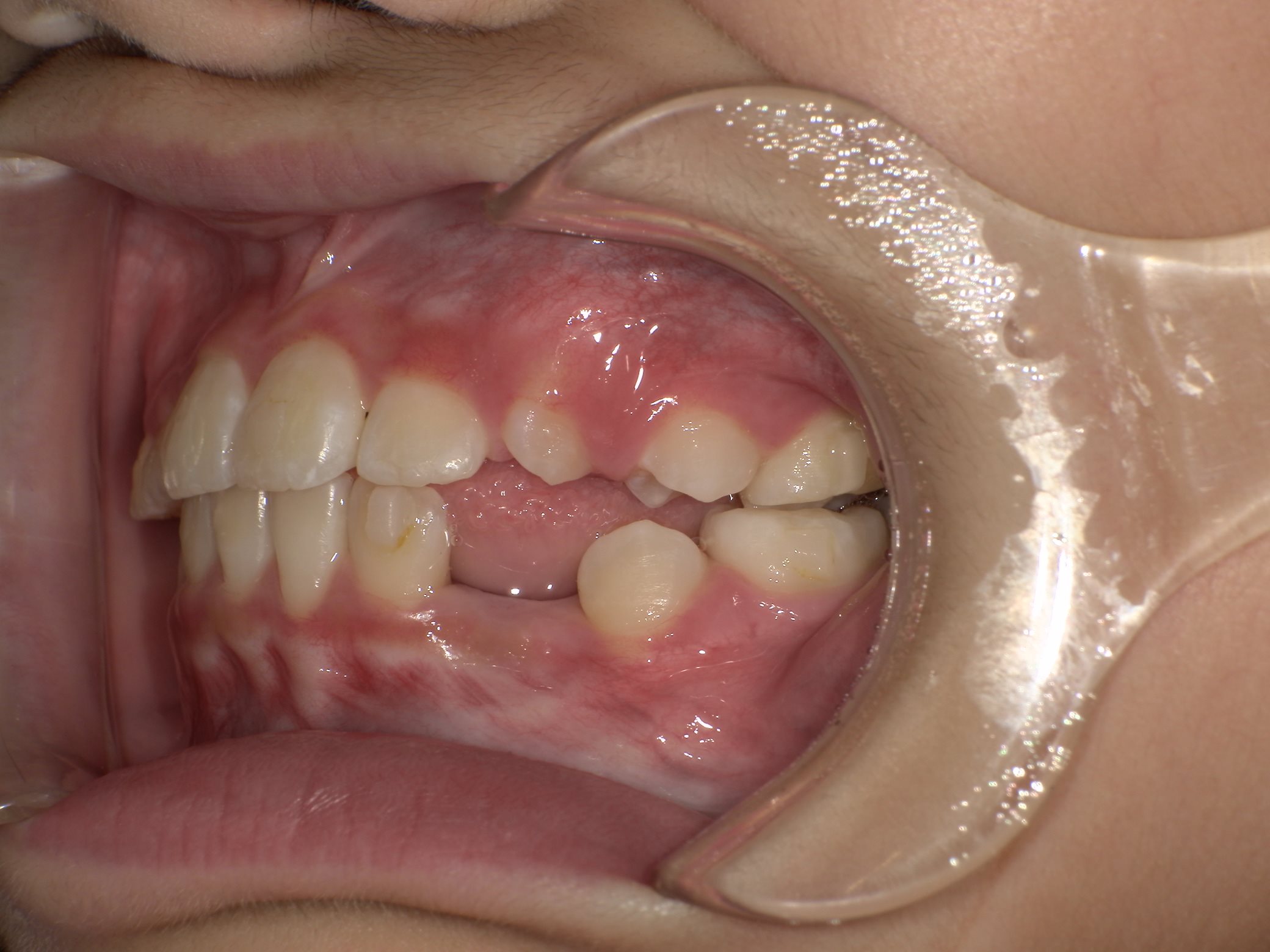 インビザラインファースト