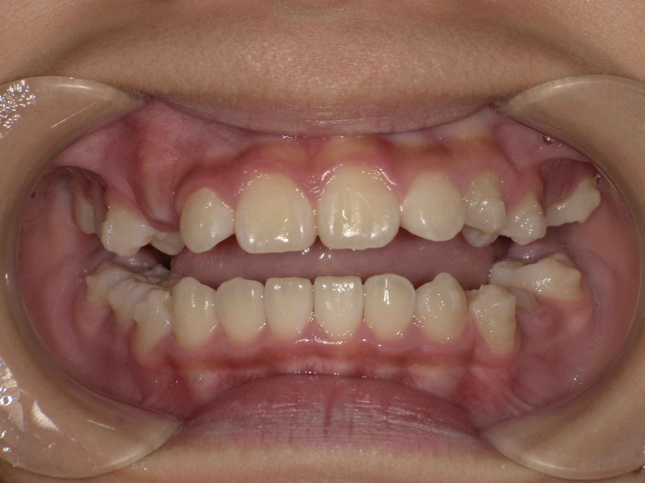 インビザラインファースト