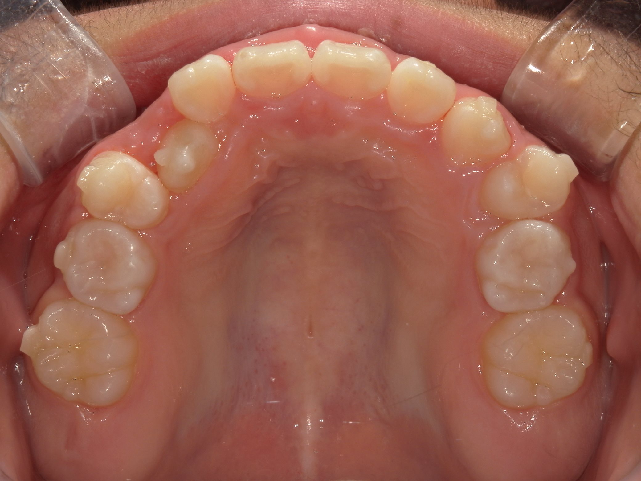 インビザラインファースト