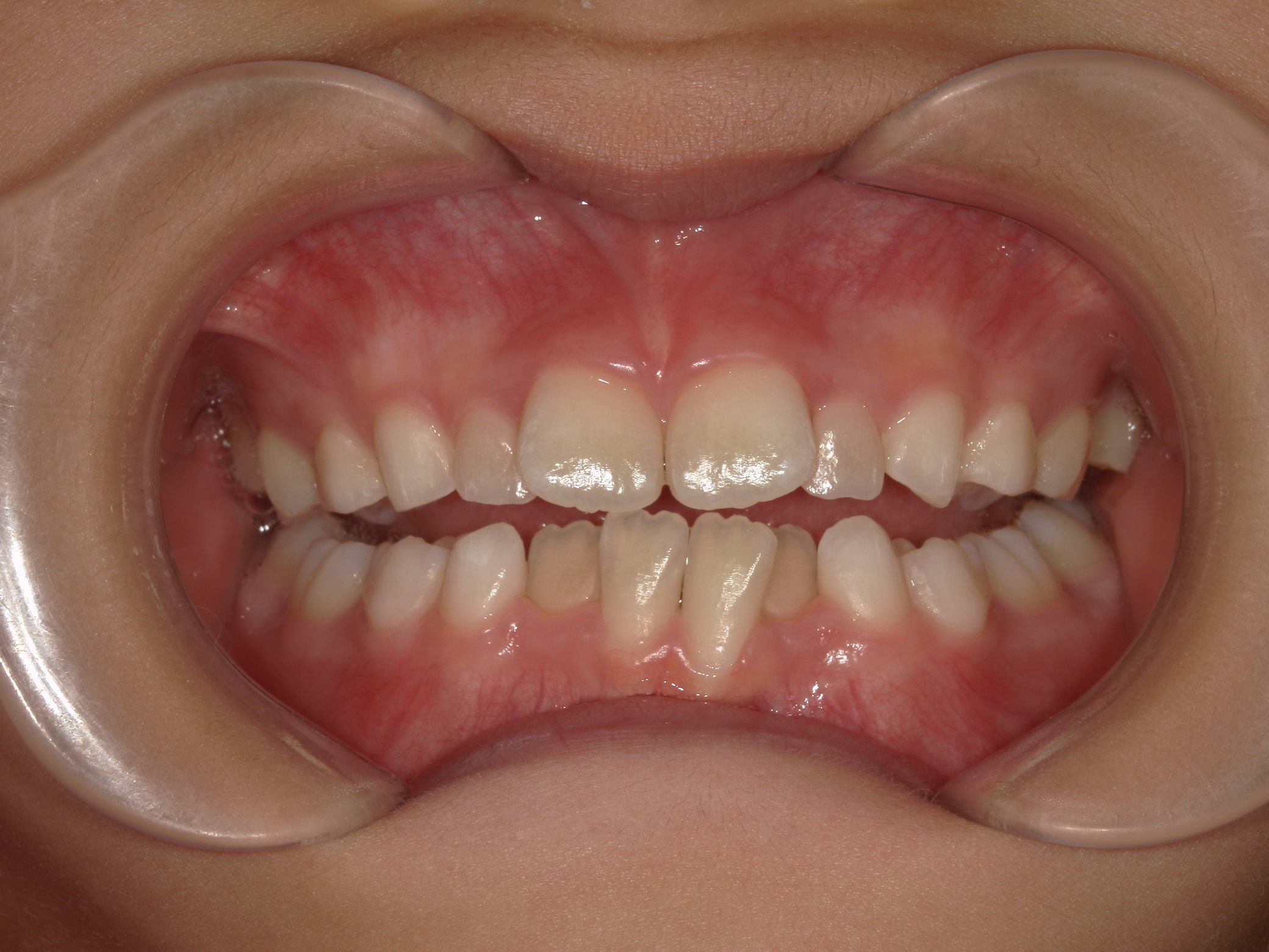 インビザラインファースト