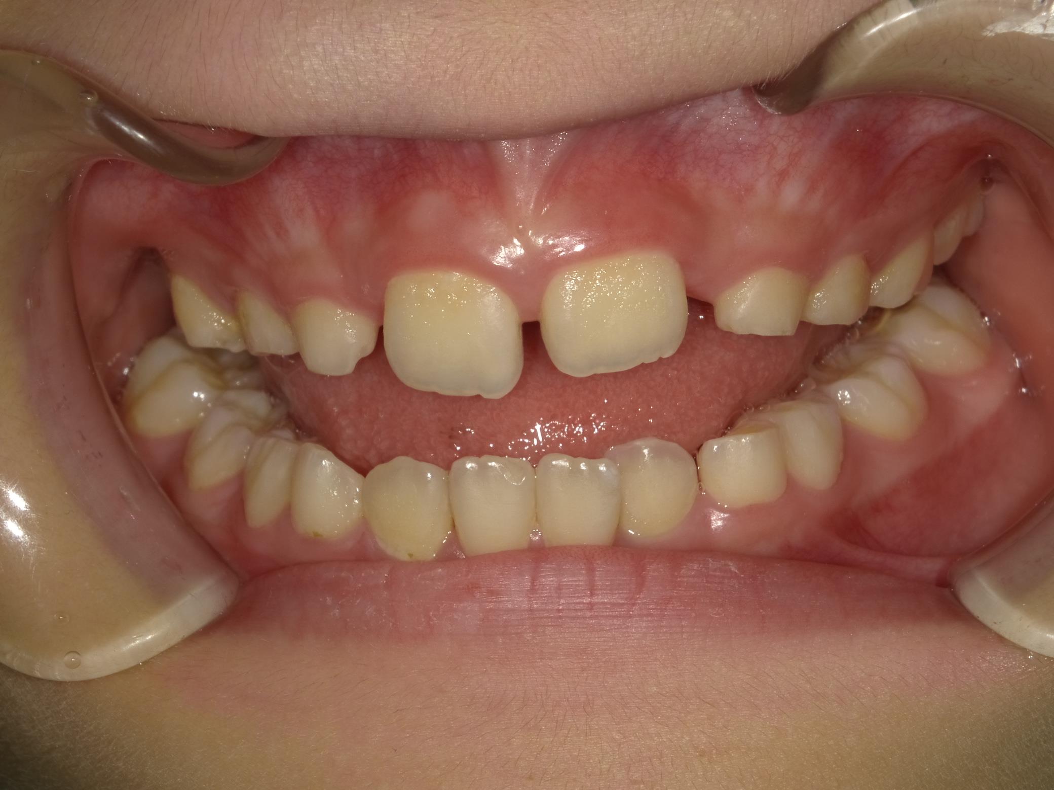 インビザラインファースト