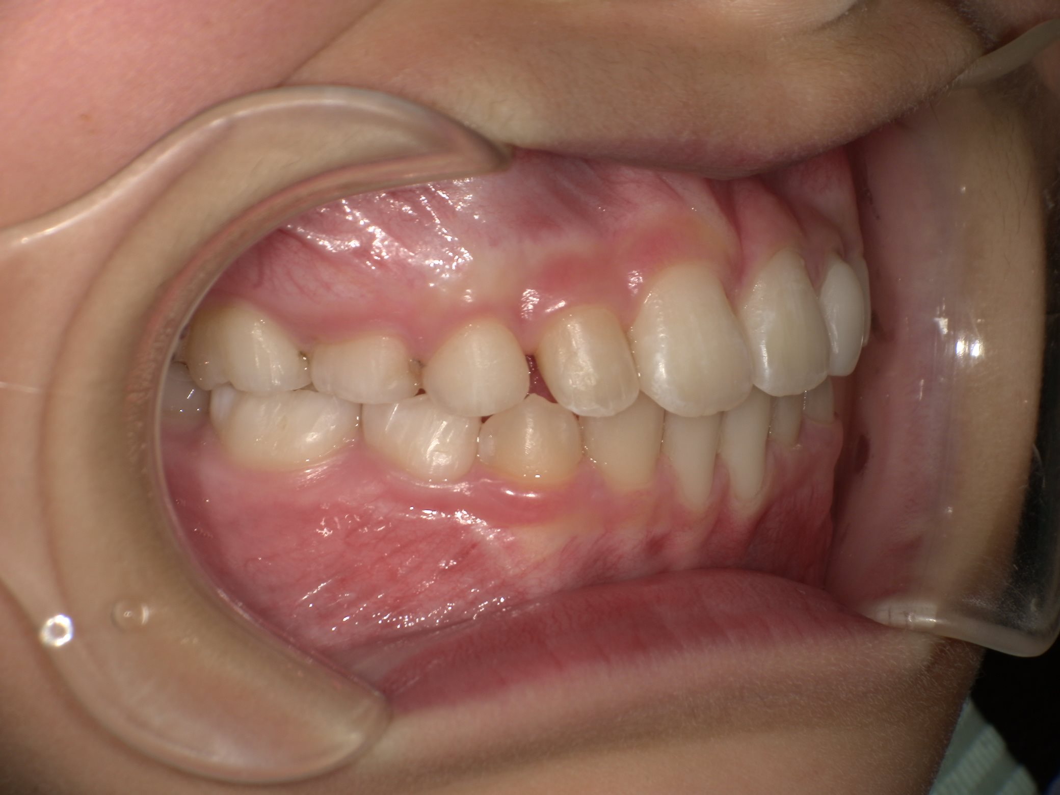 インビザラインファースト