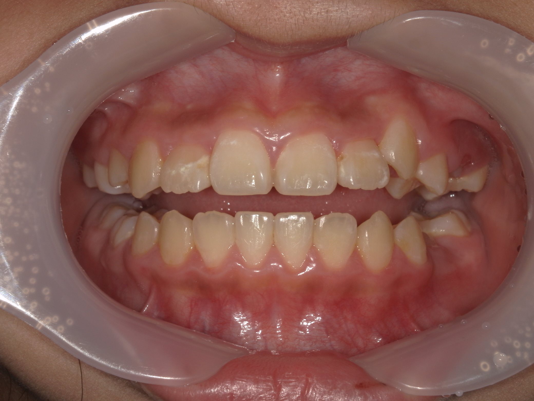 インビザラインファースト