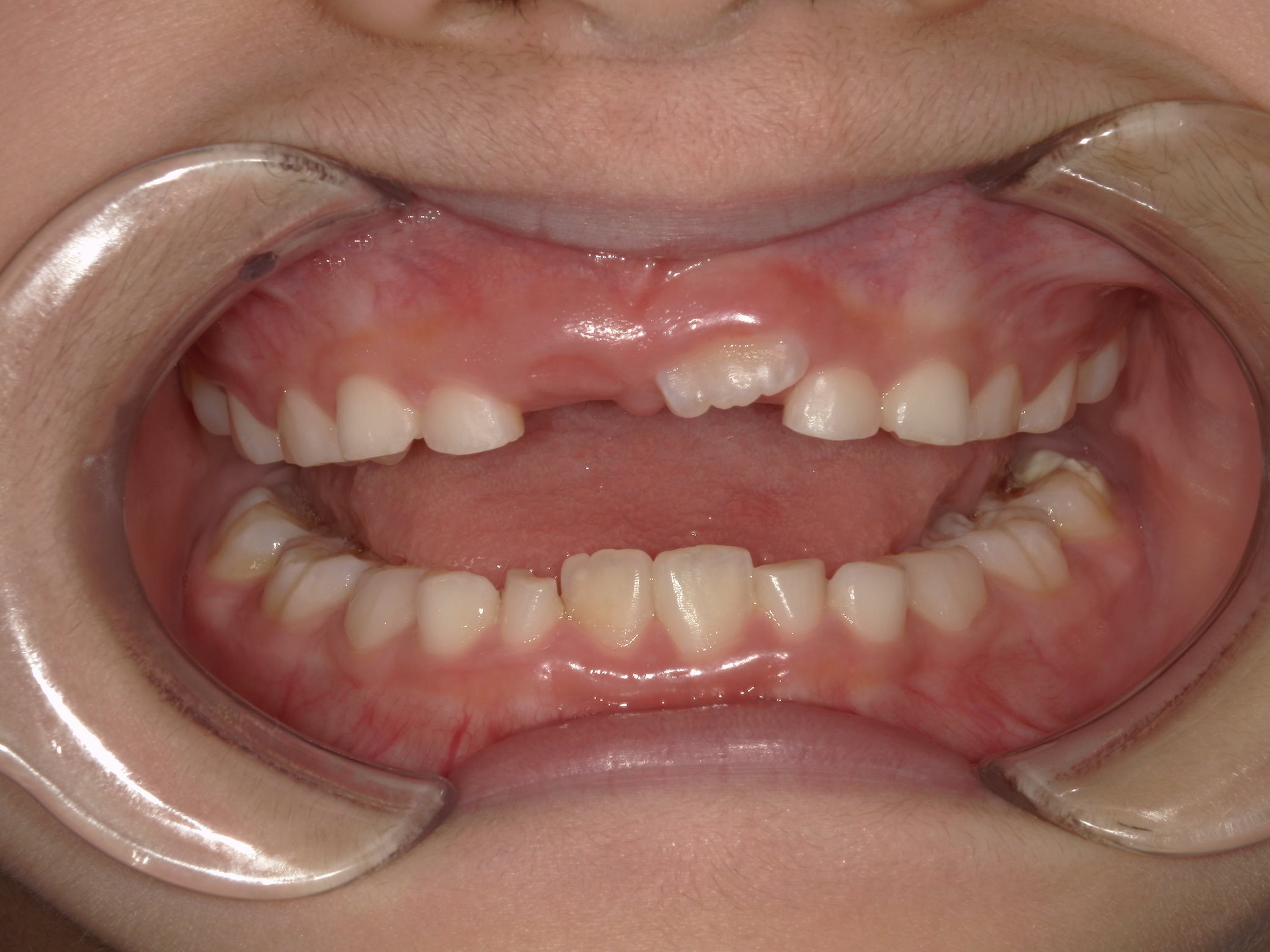 インビザラインファースト