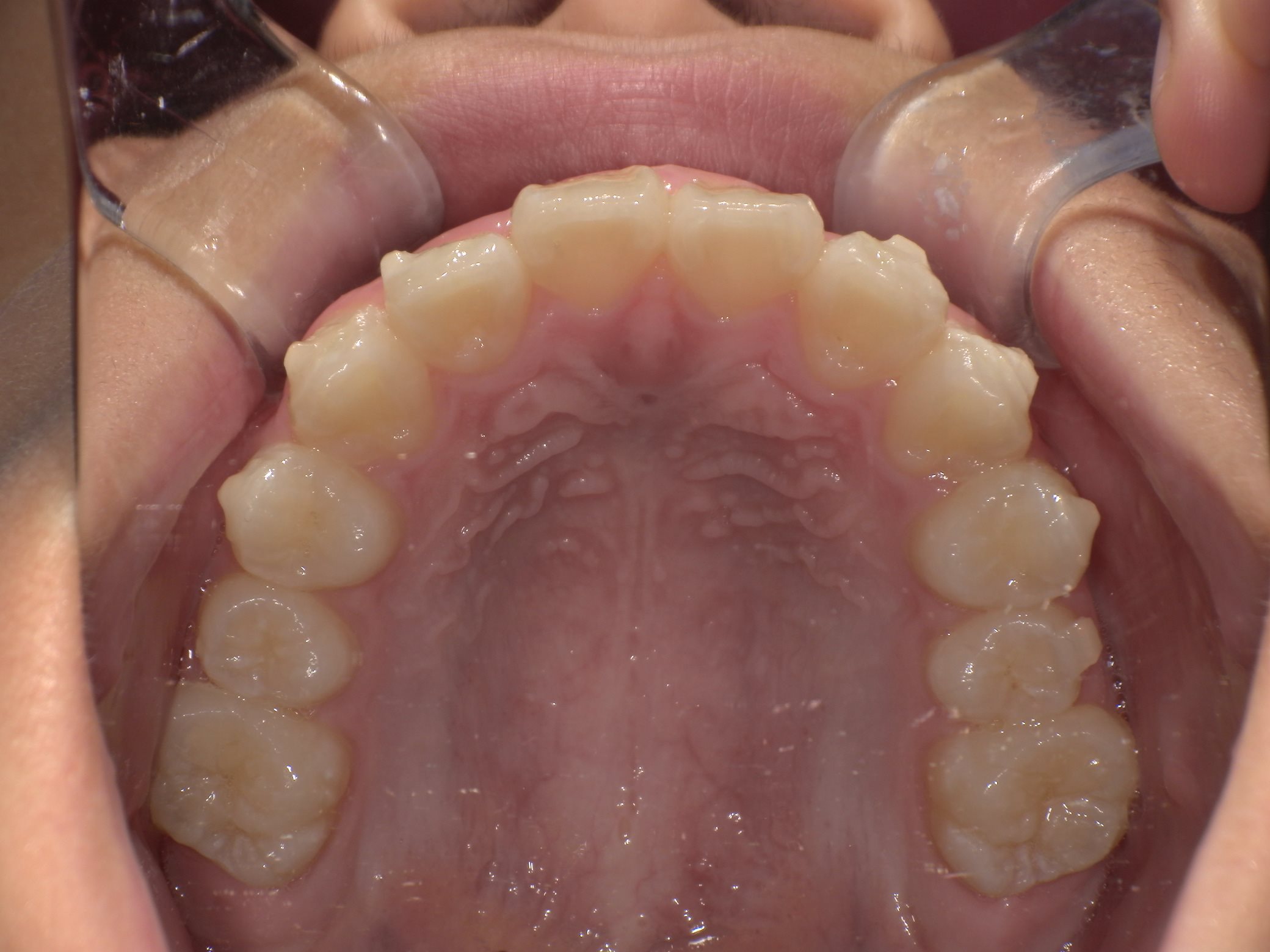 インビザラインファースト