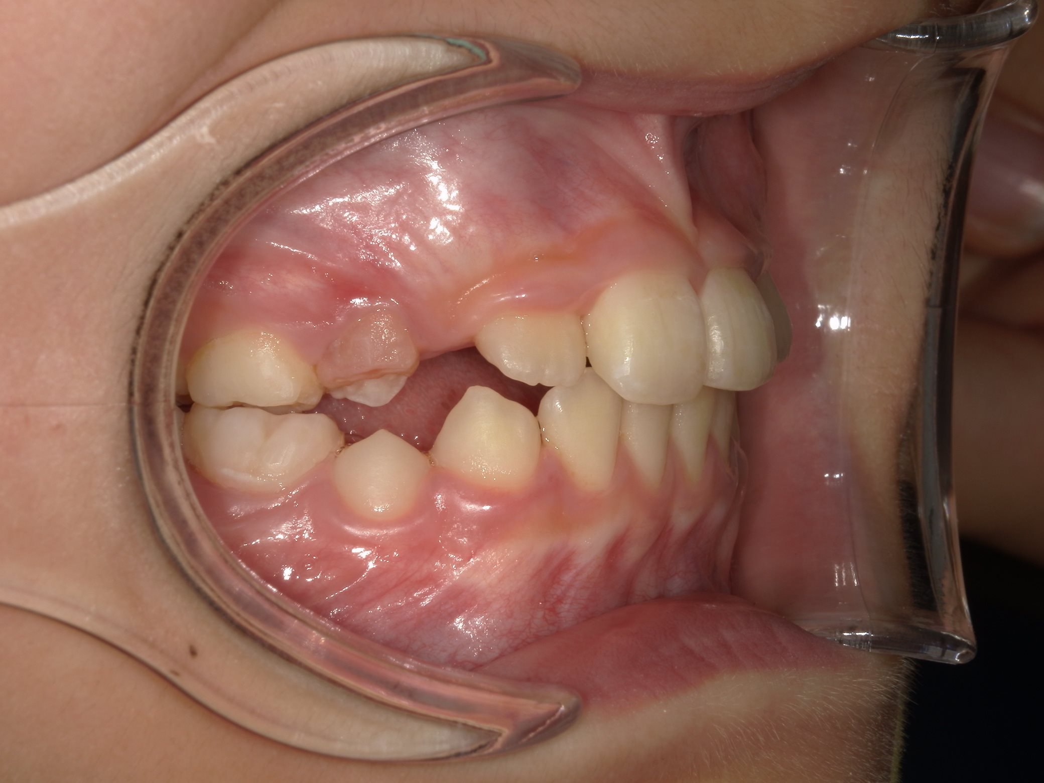 インビザラインファースト