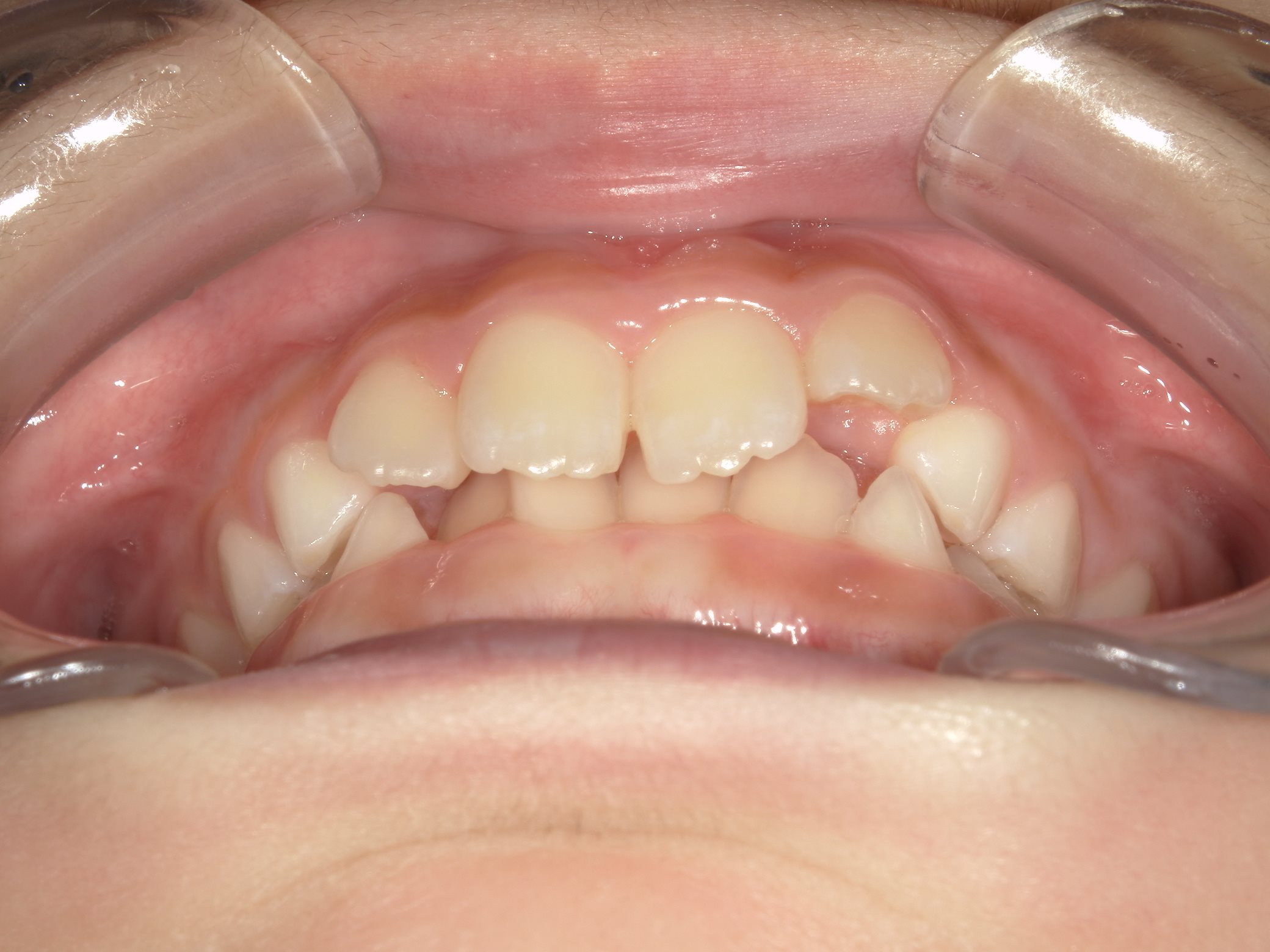 インビザラインファースト