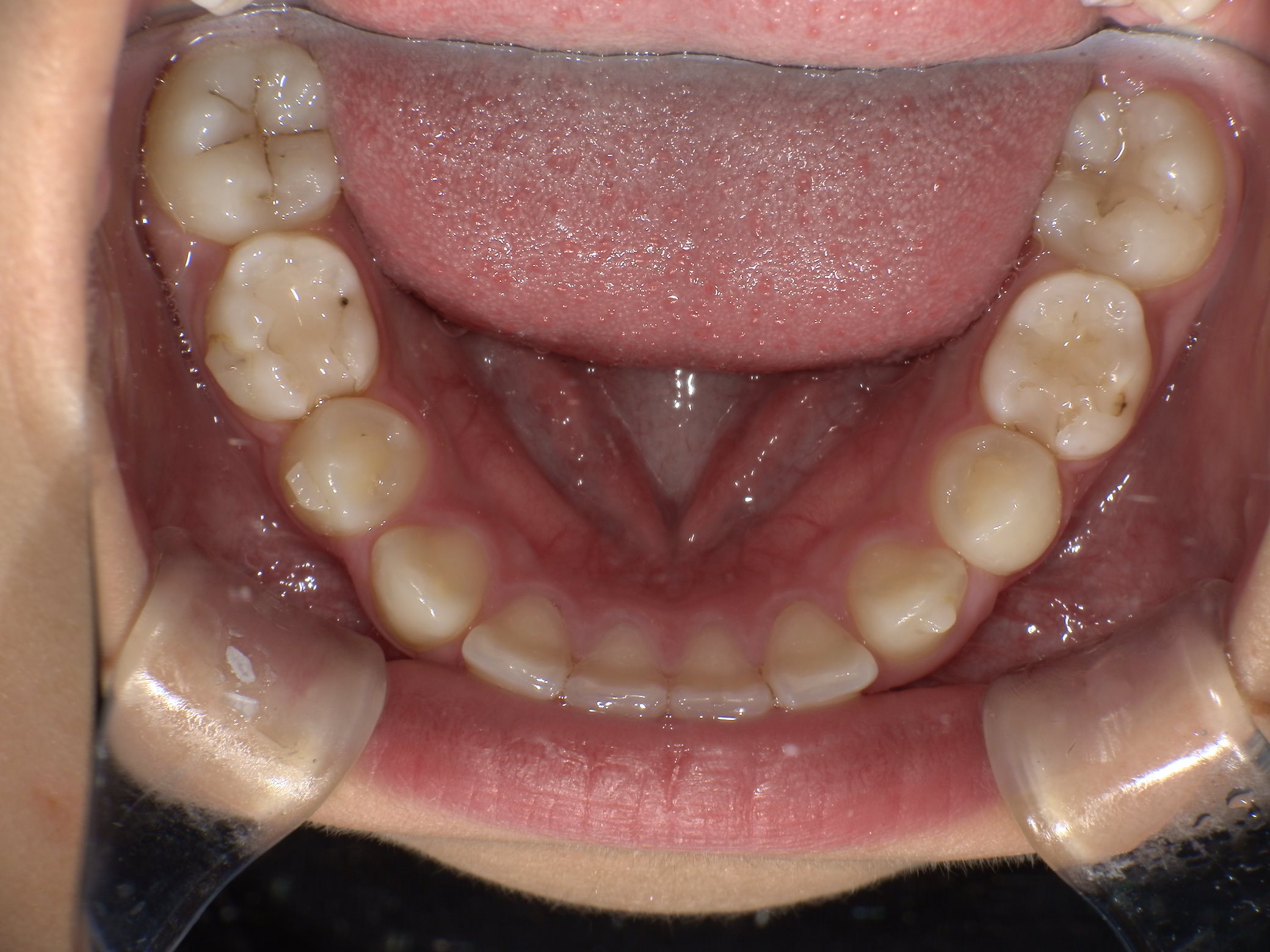 インビザラインファースト