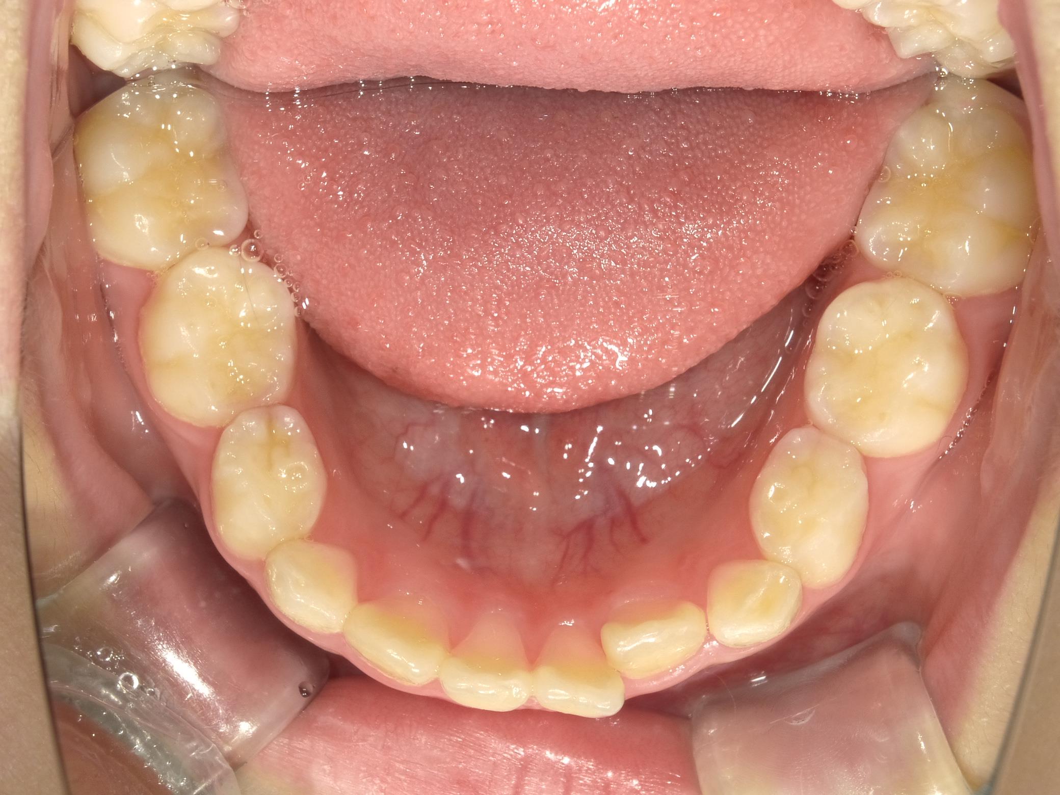 インビザラインファースト