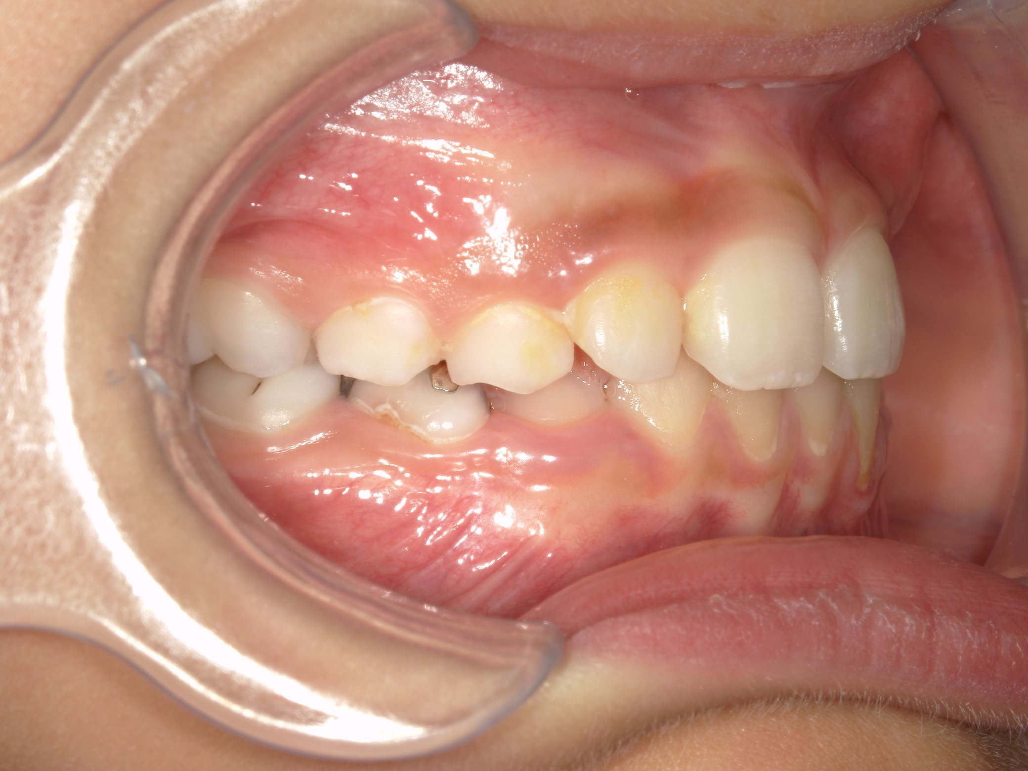 インビザラインファースト