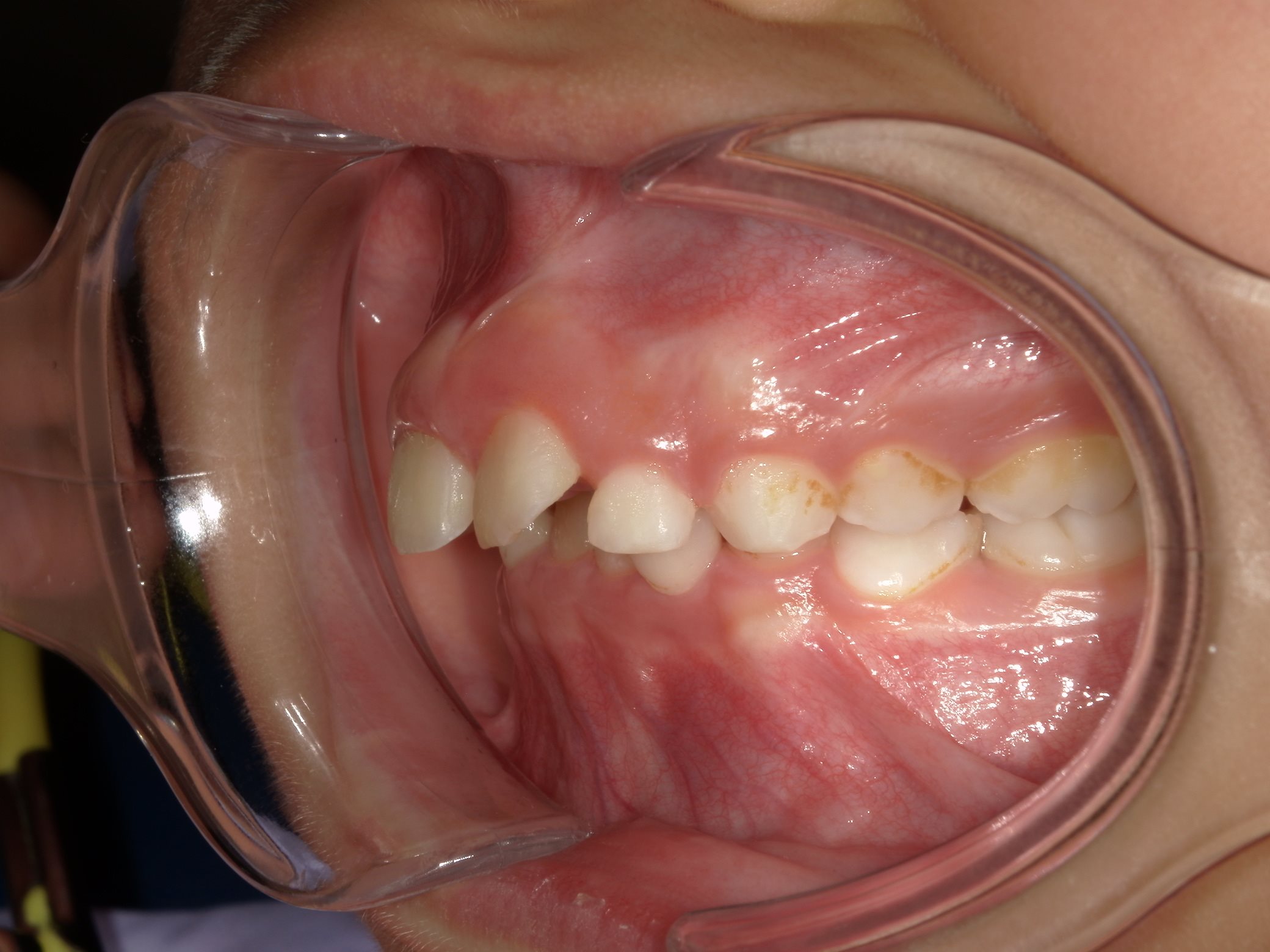 インビザラインファースト