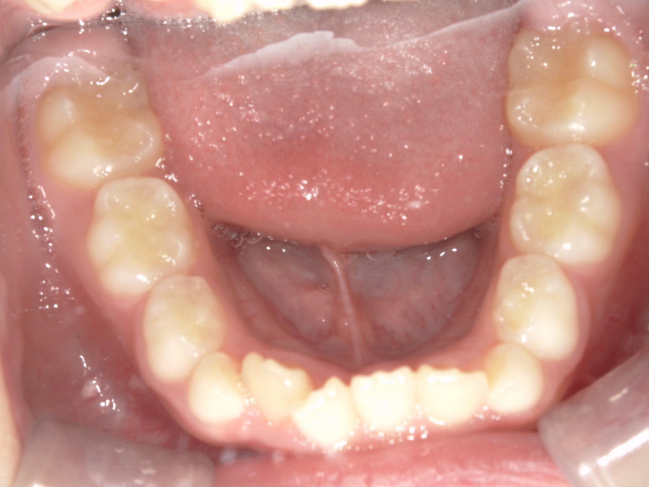 インビザラインファースト