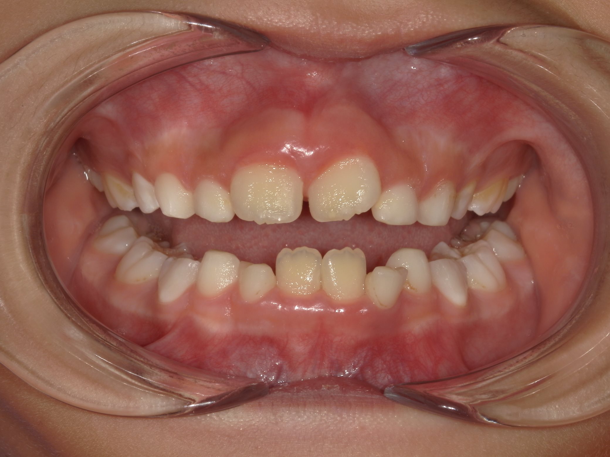 インビザラインファースト