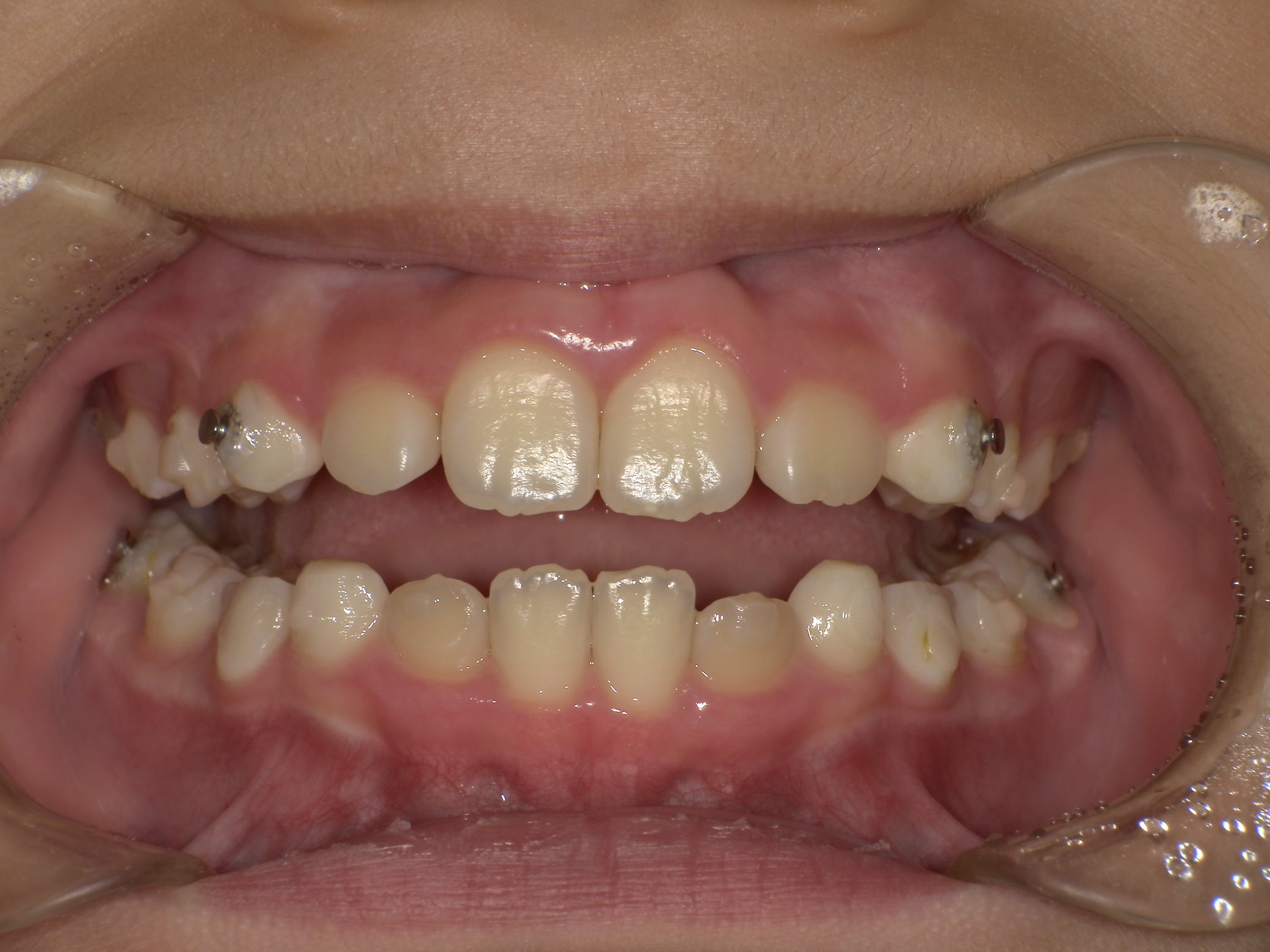 インビザラインファースト