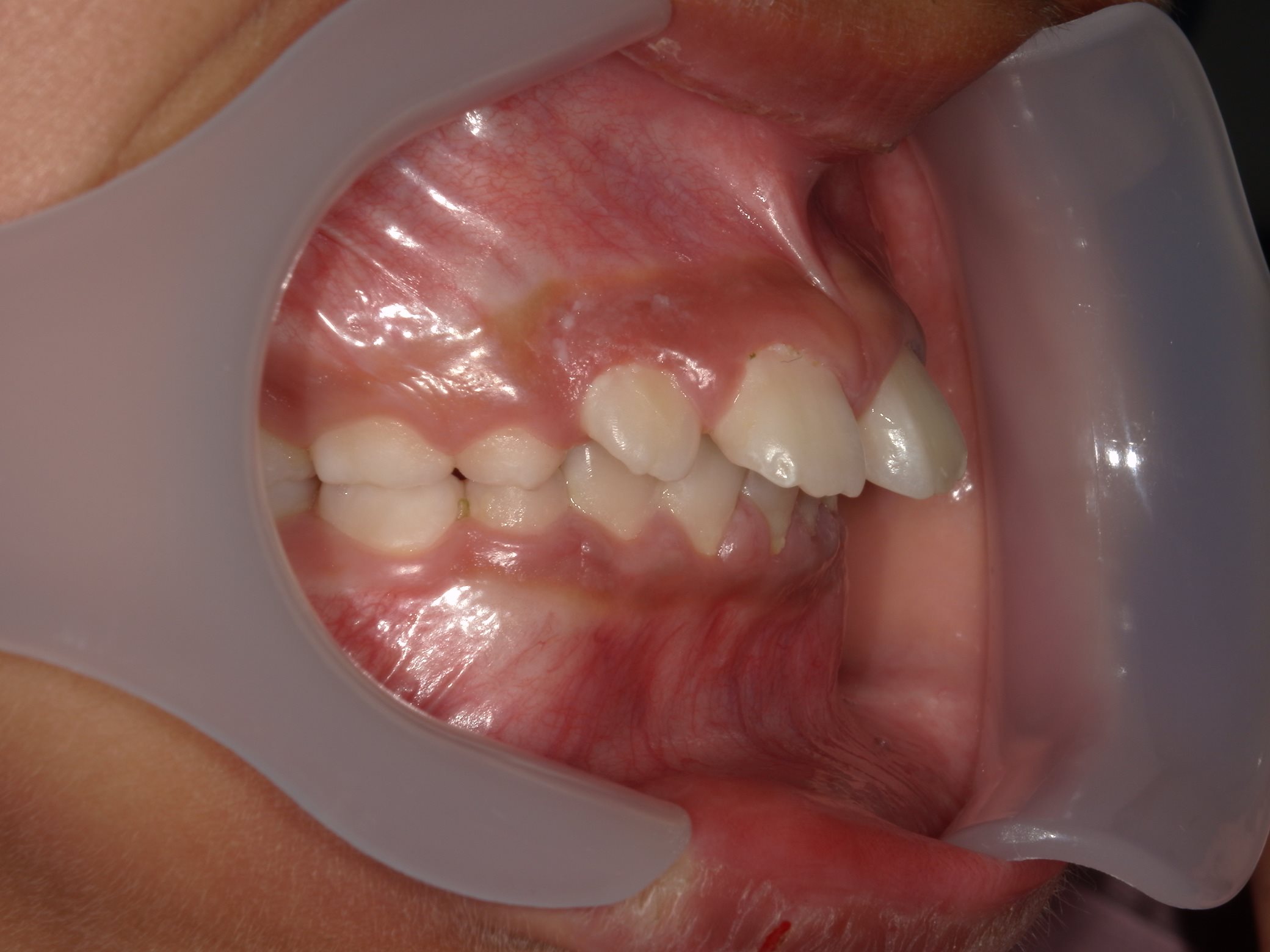 インビザラインファースト