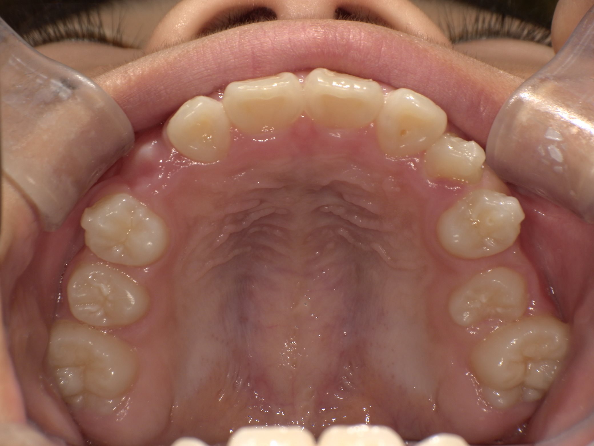 インビザラインファースト