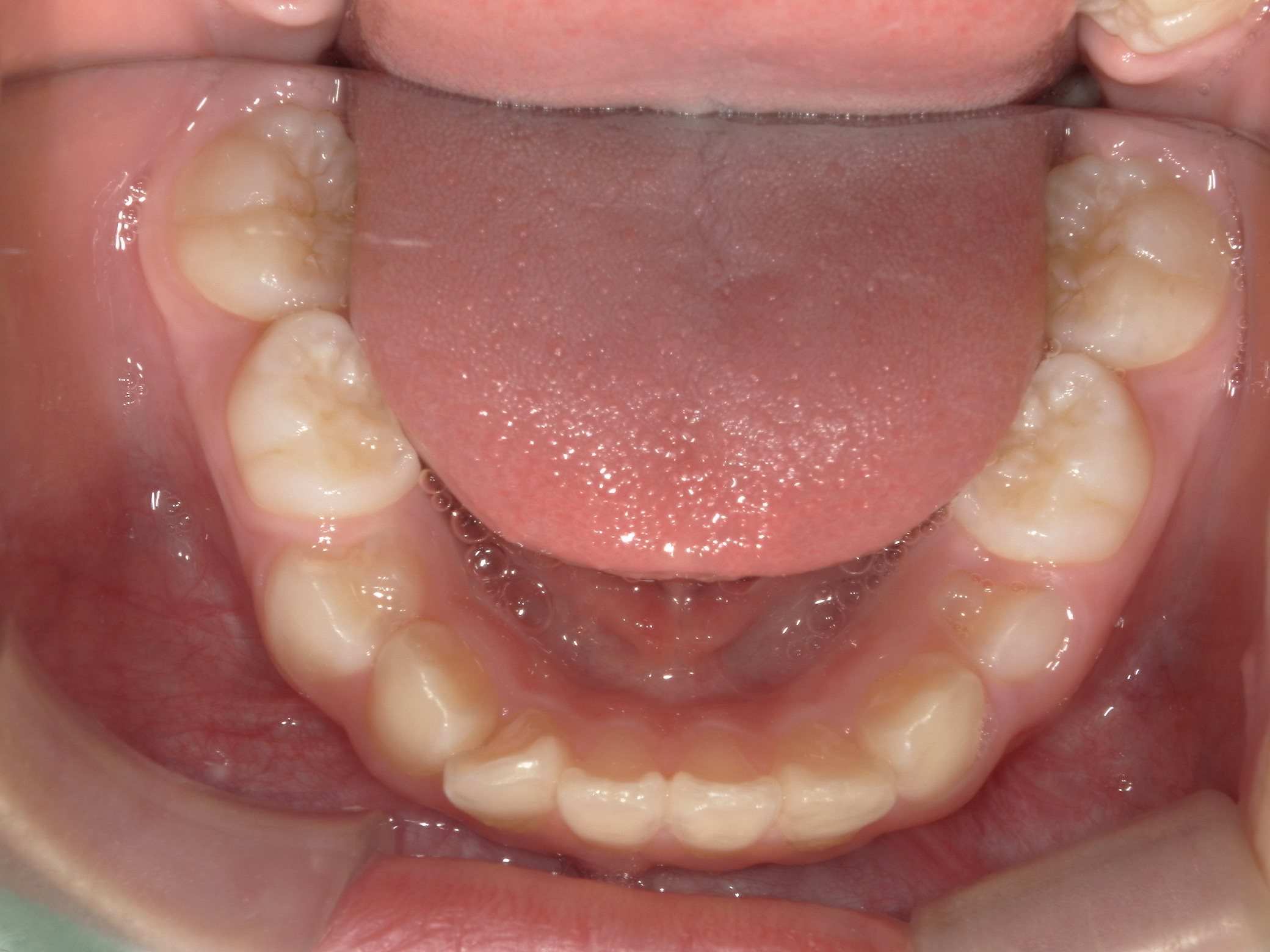 インビザラインファースト