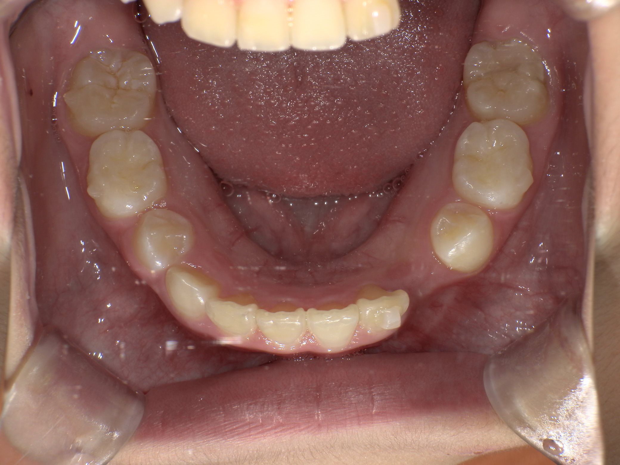 インビザラインファースト