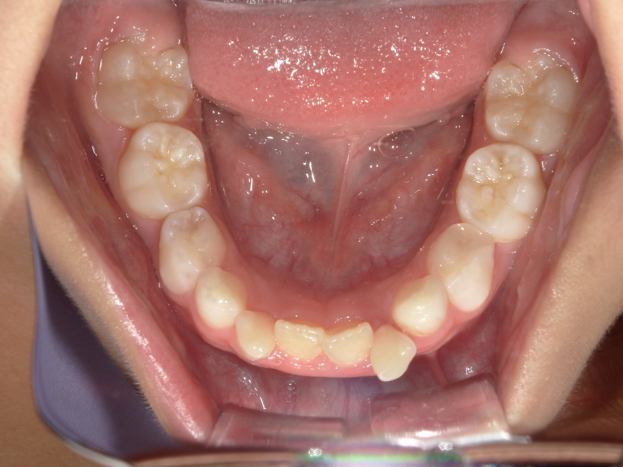 インビザラインファースト