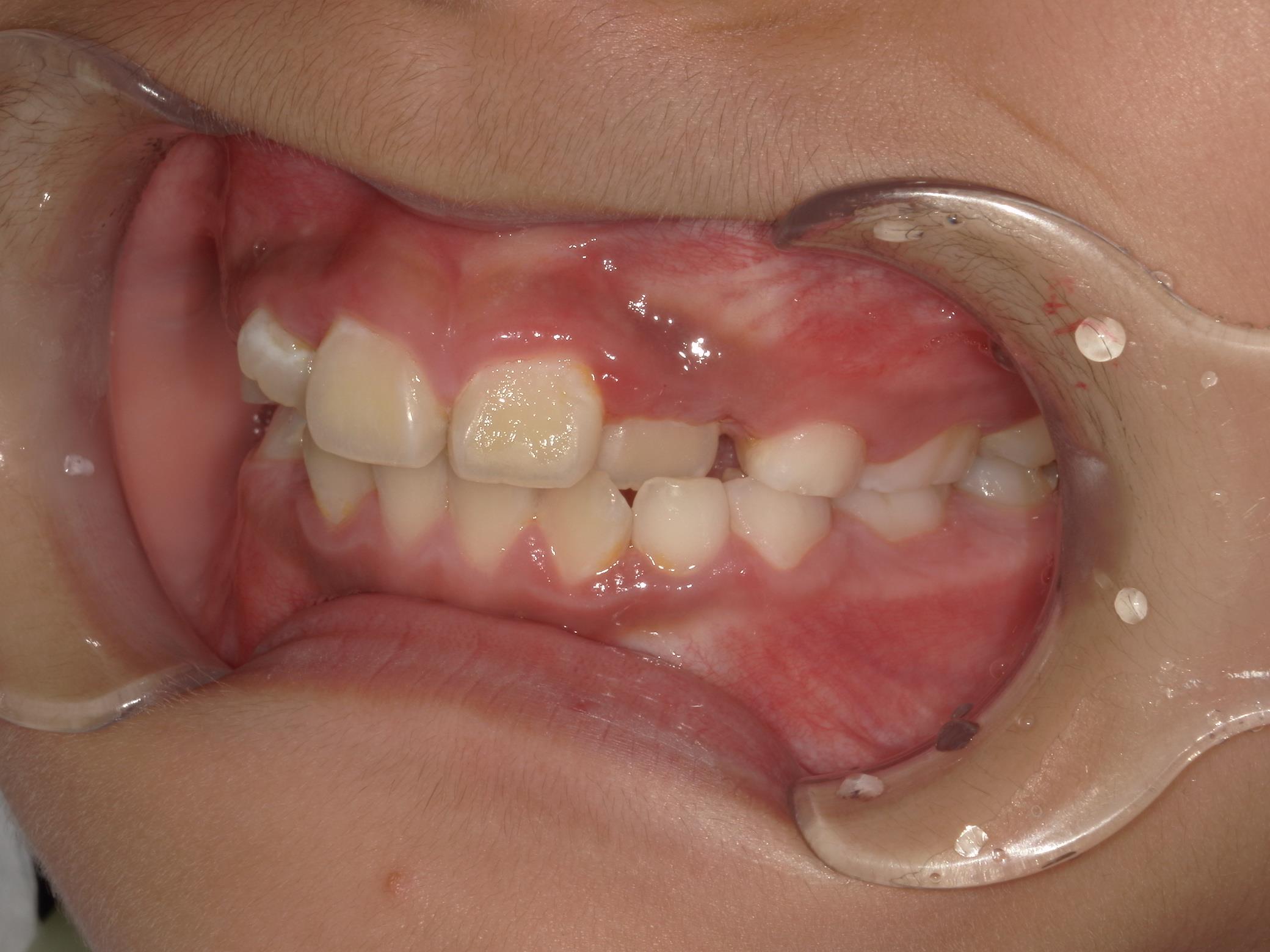 インビザラインファースト