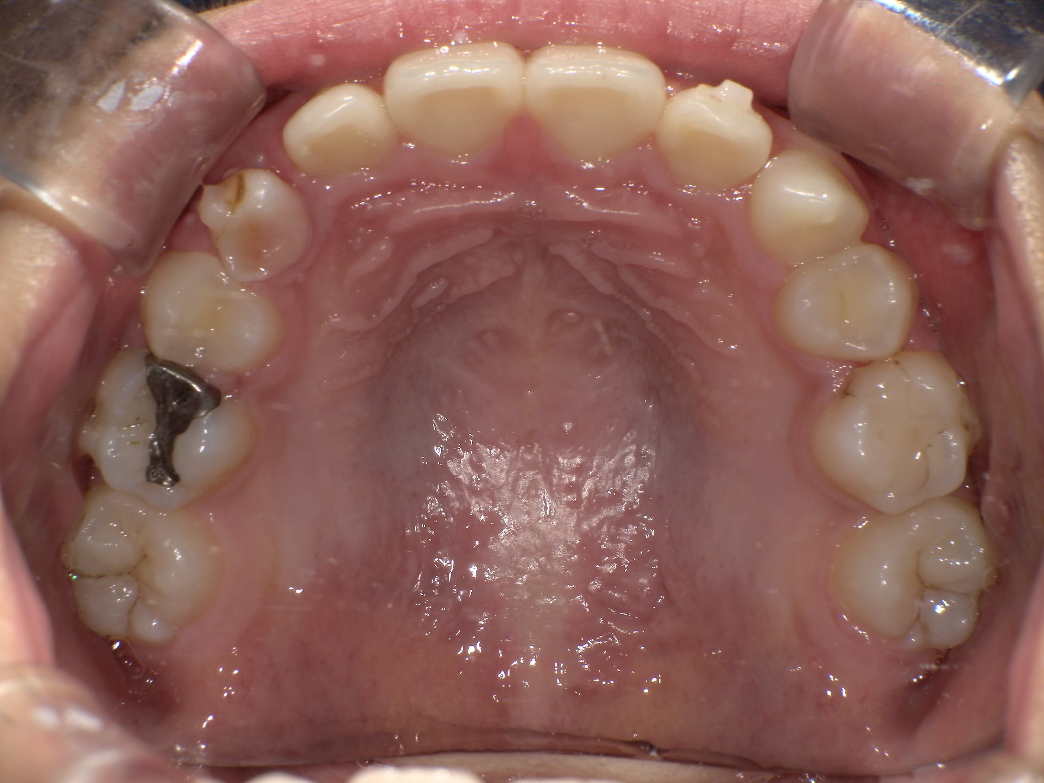 インビザラインファースト