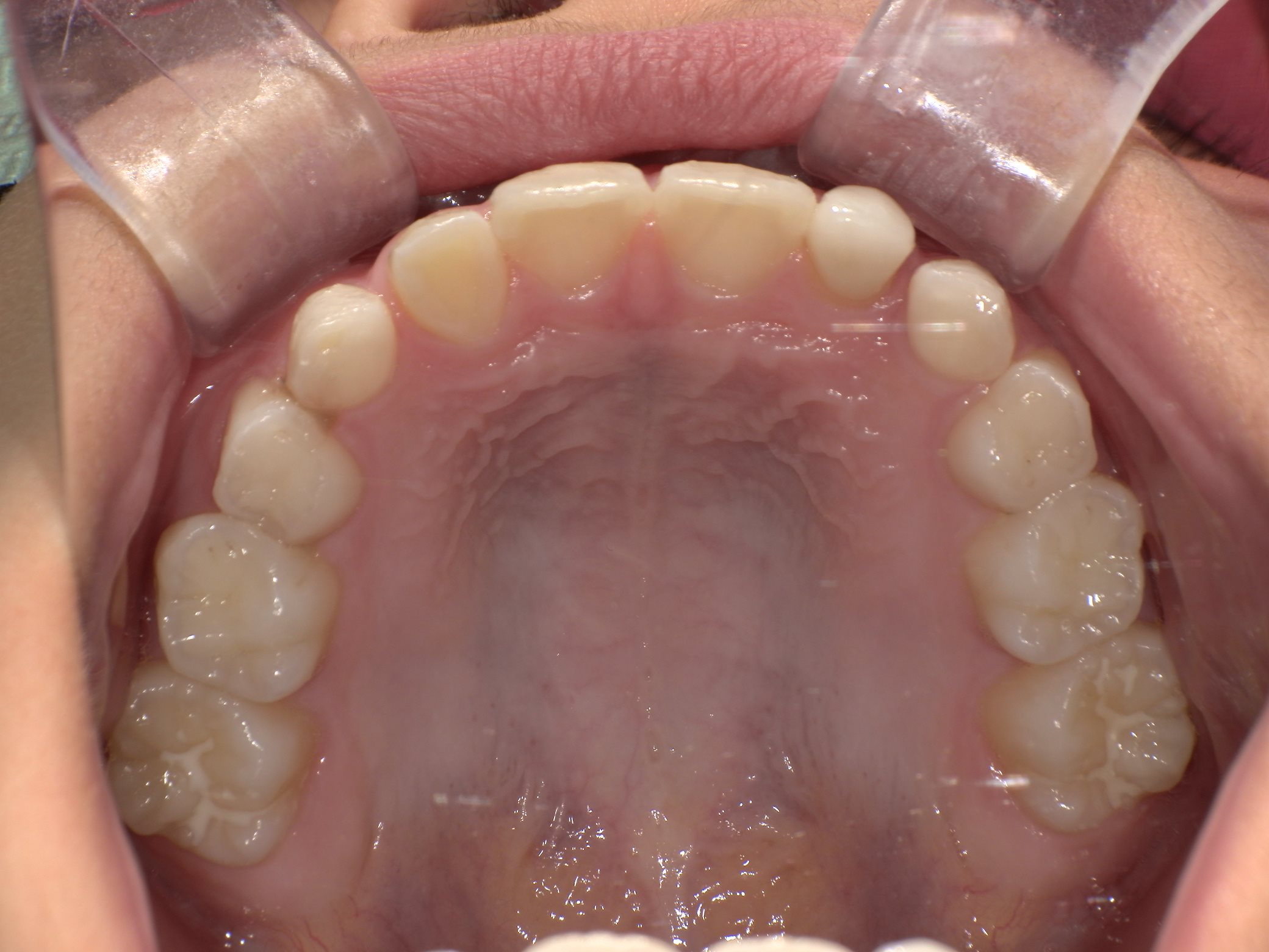 インビザラインファースト