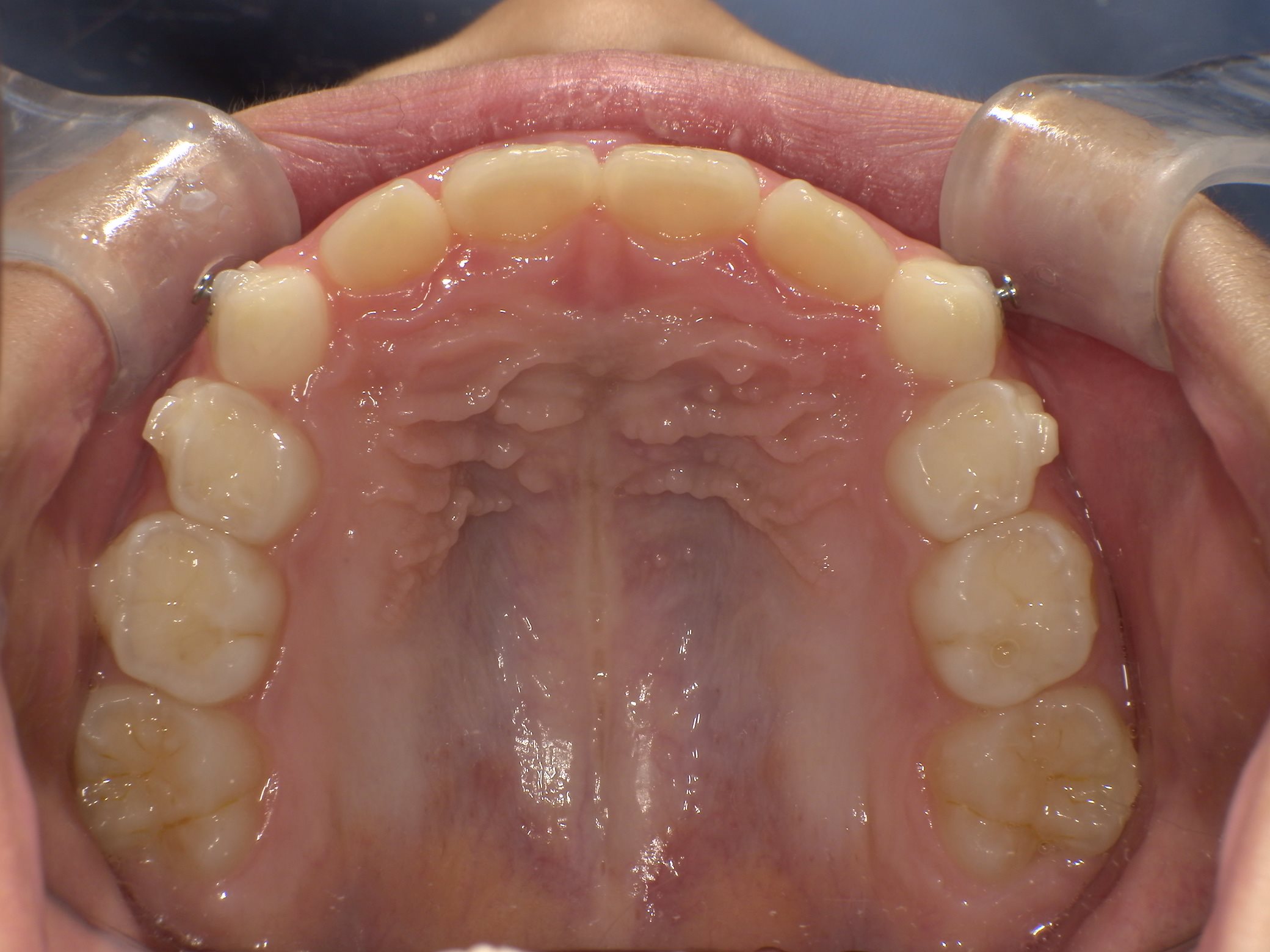 インビザラインファースト