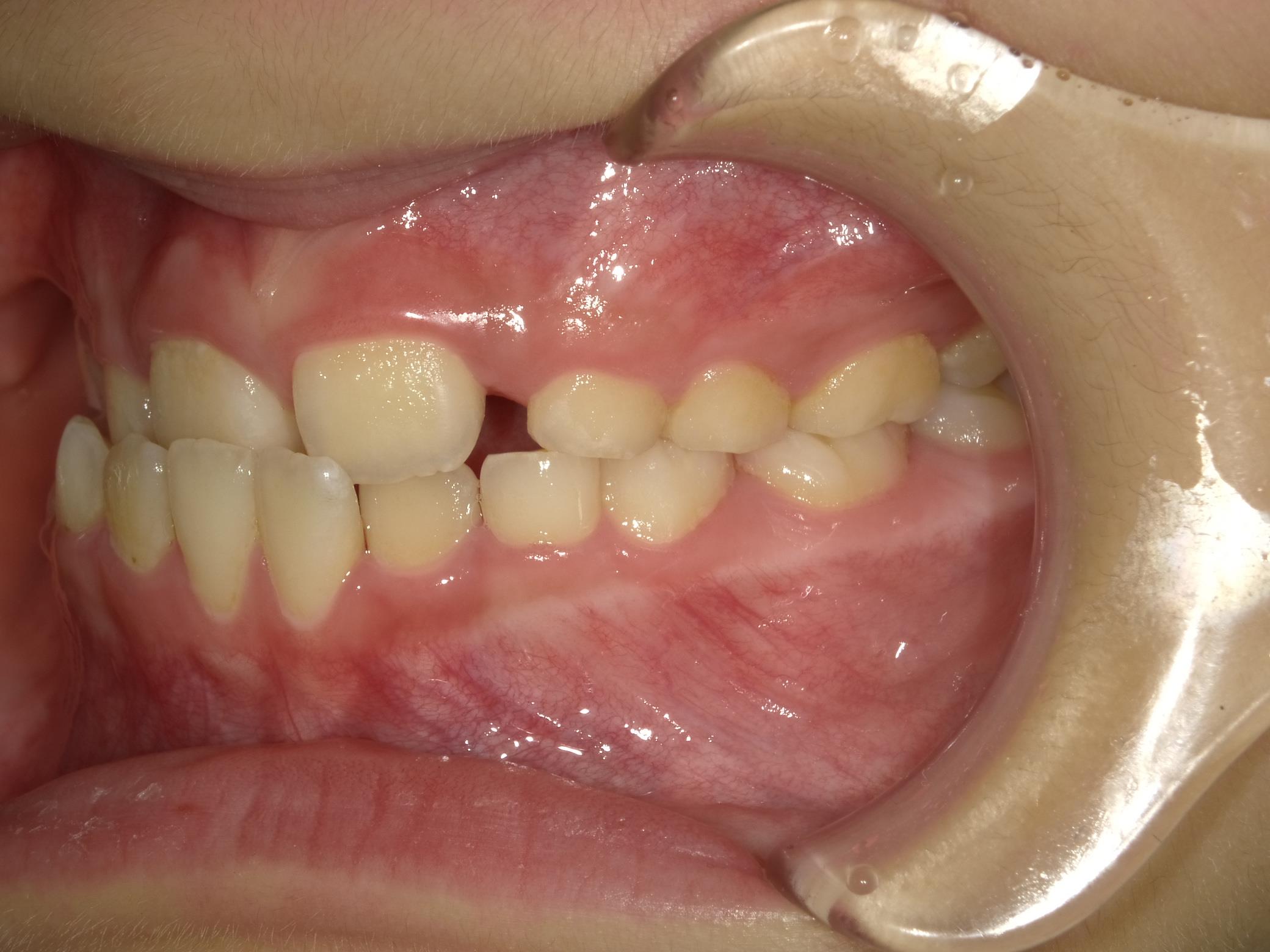 インビザラインファースト