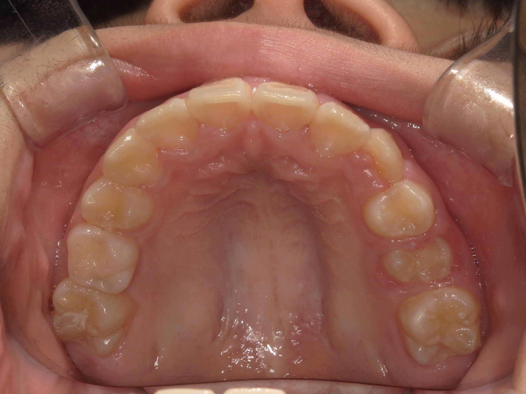 インビザラインファースト