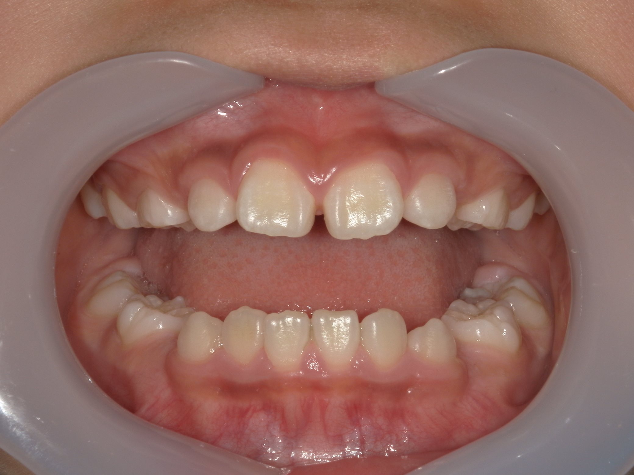 インビザラインファースト