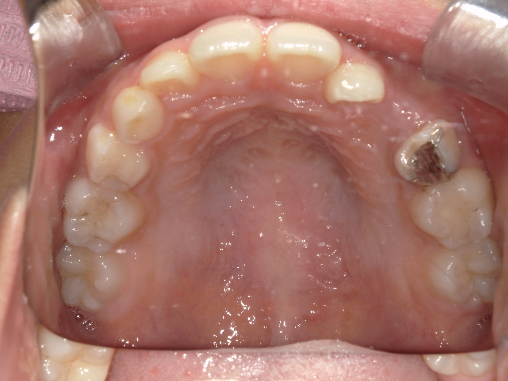 インビザラインファースト