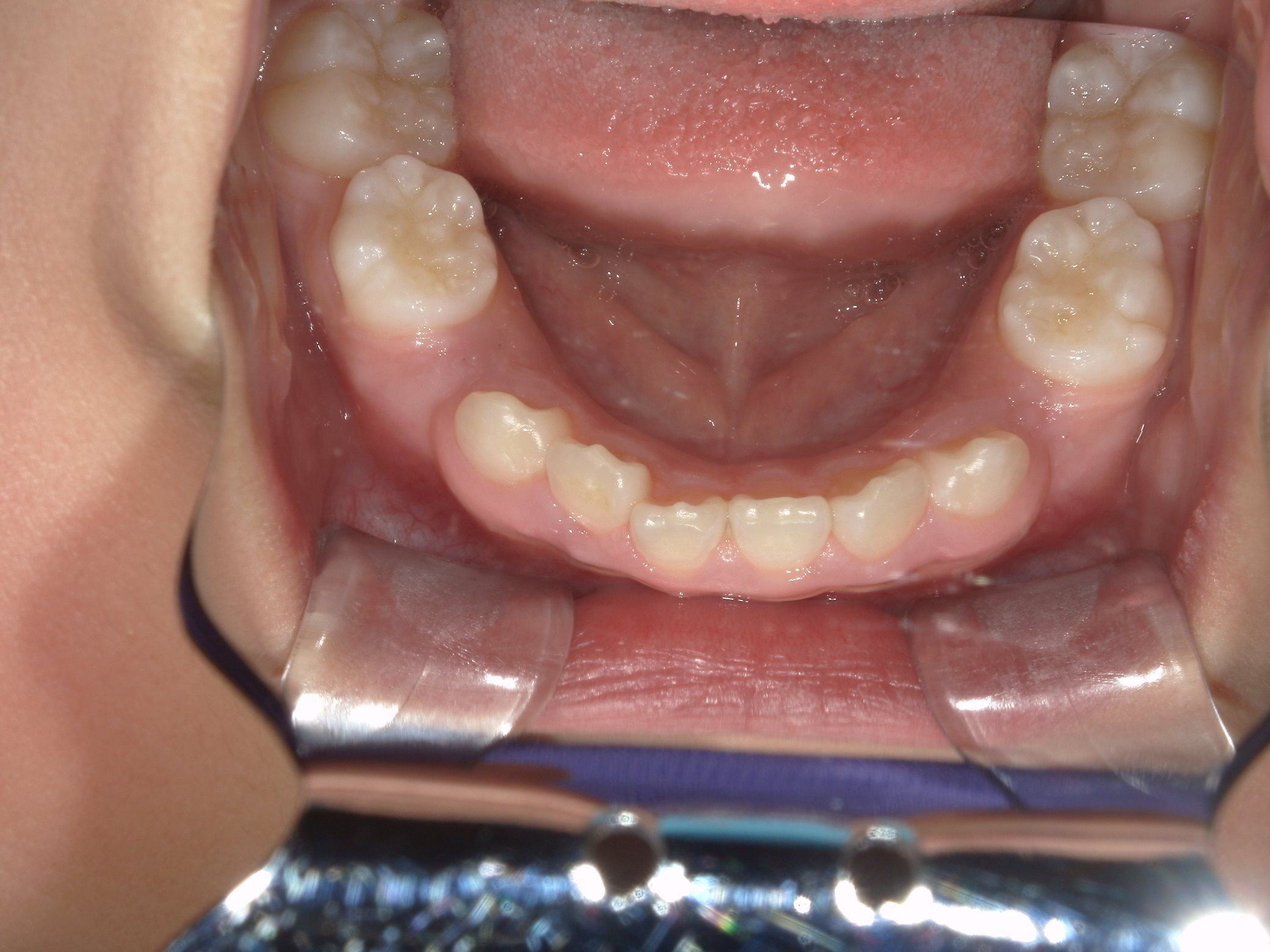 インビザラインファースト