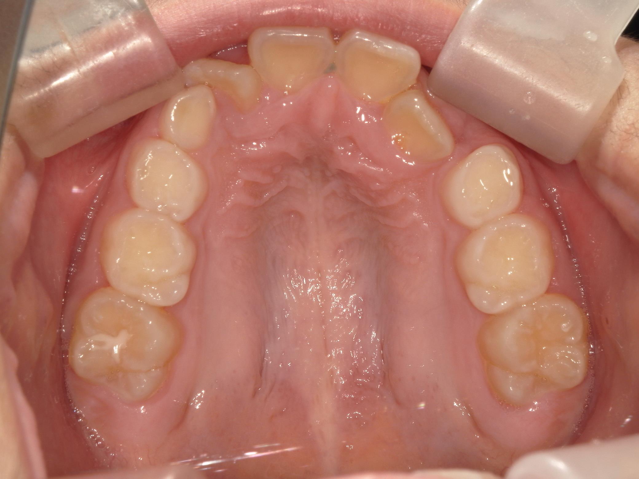 インビザラインファースト