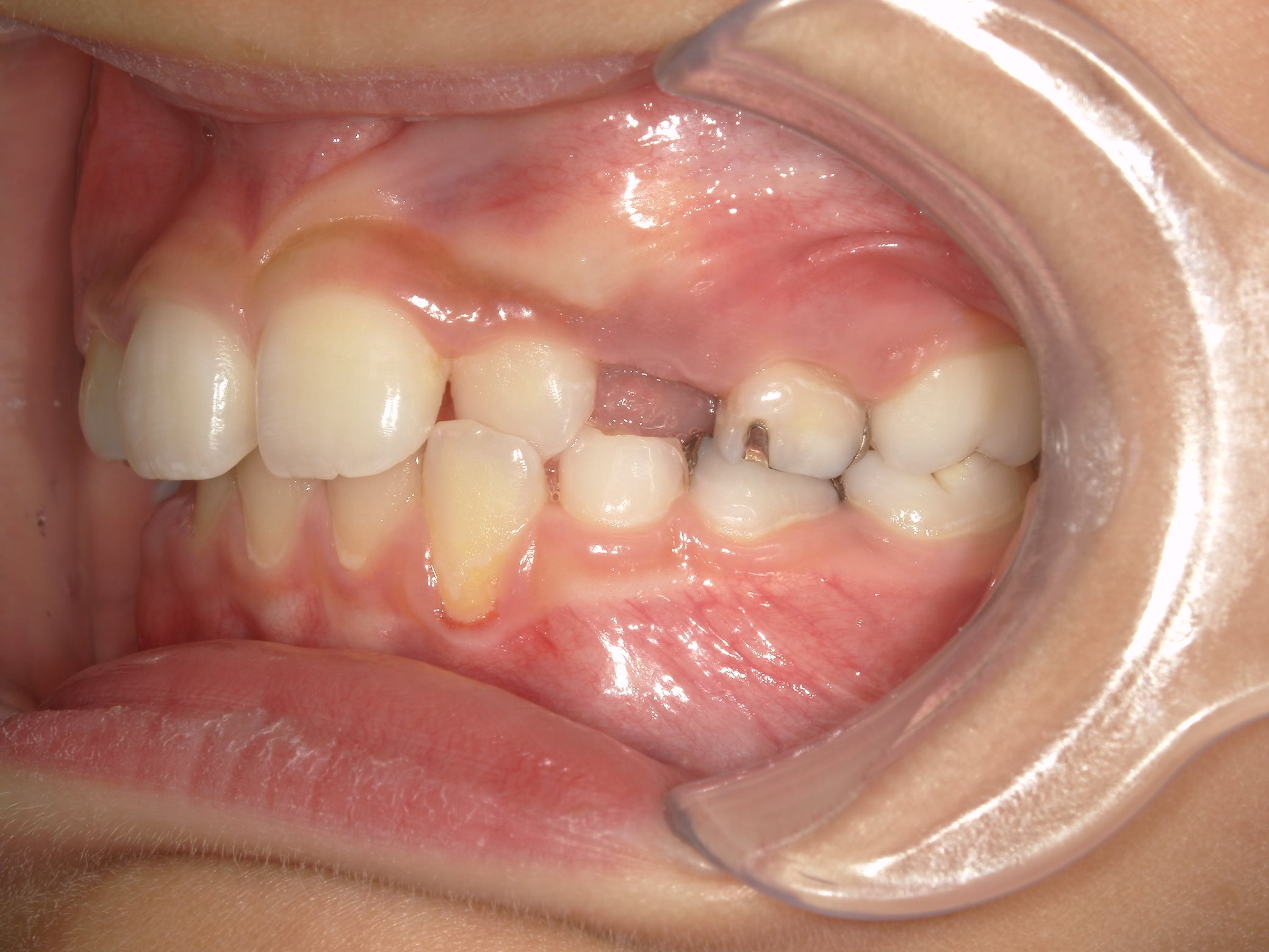 インビザラインファースト