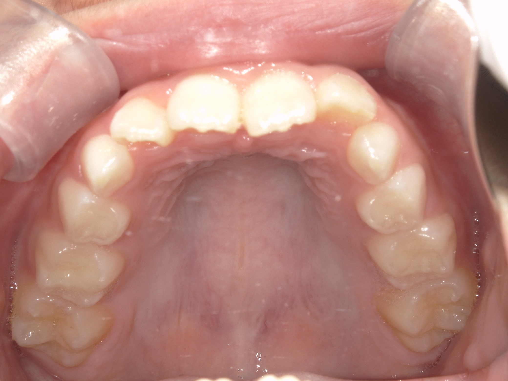 インビザラインファースト