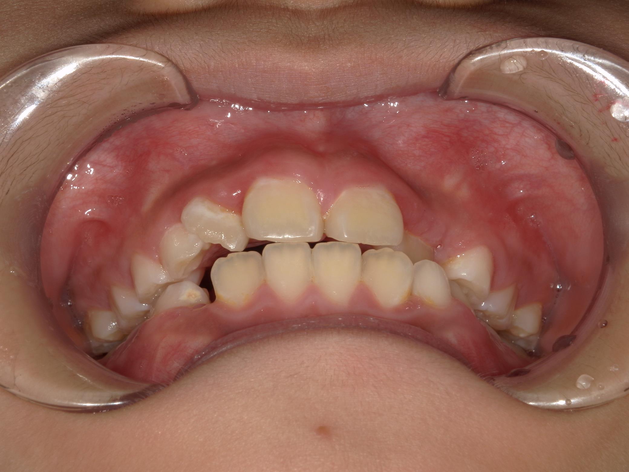 インビザラインファースト