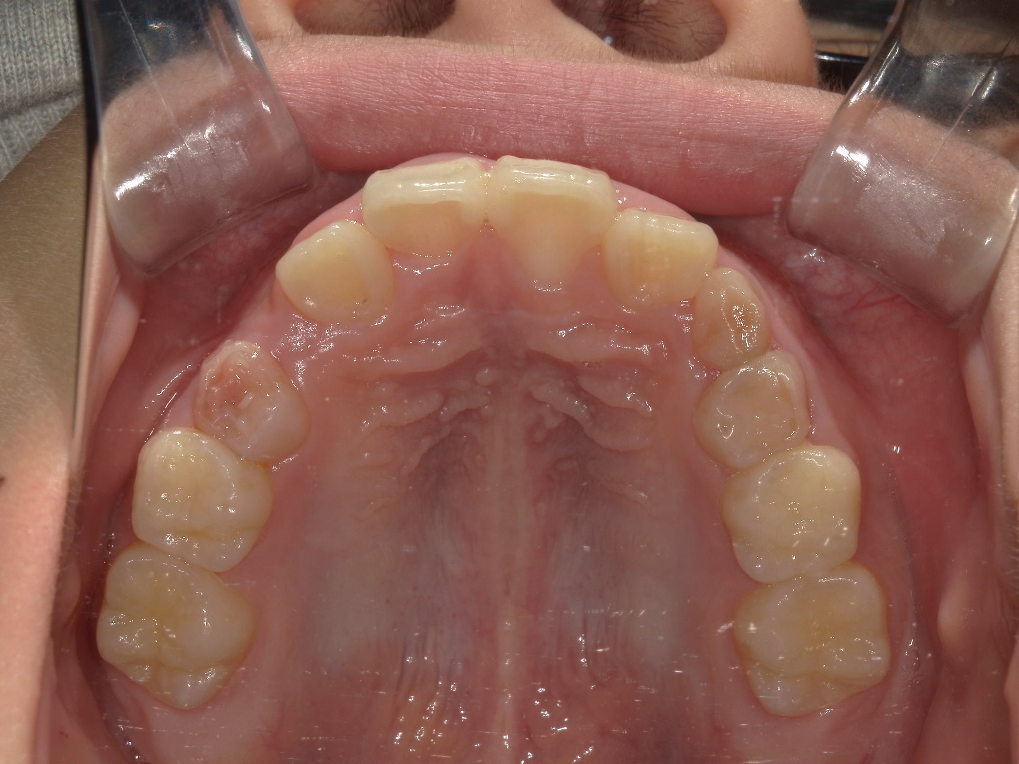 インビザラインファースト