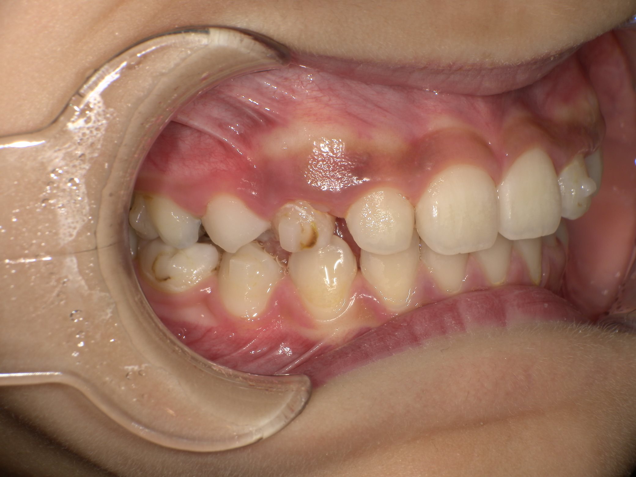 インビザラインファースト