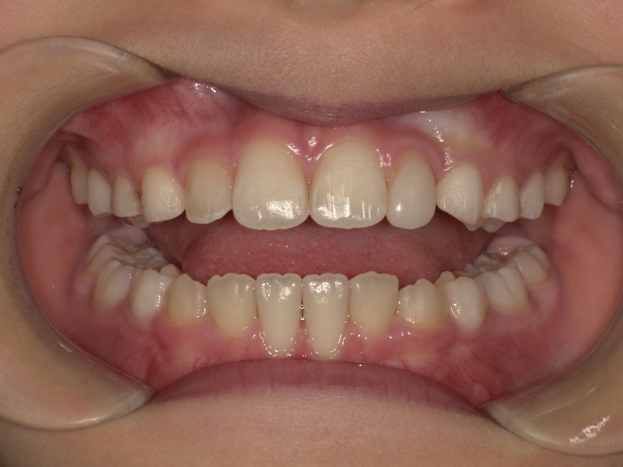 インビザラインファースト