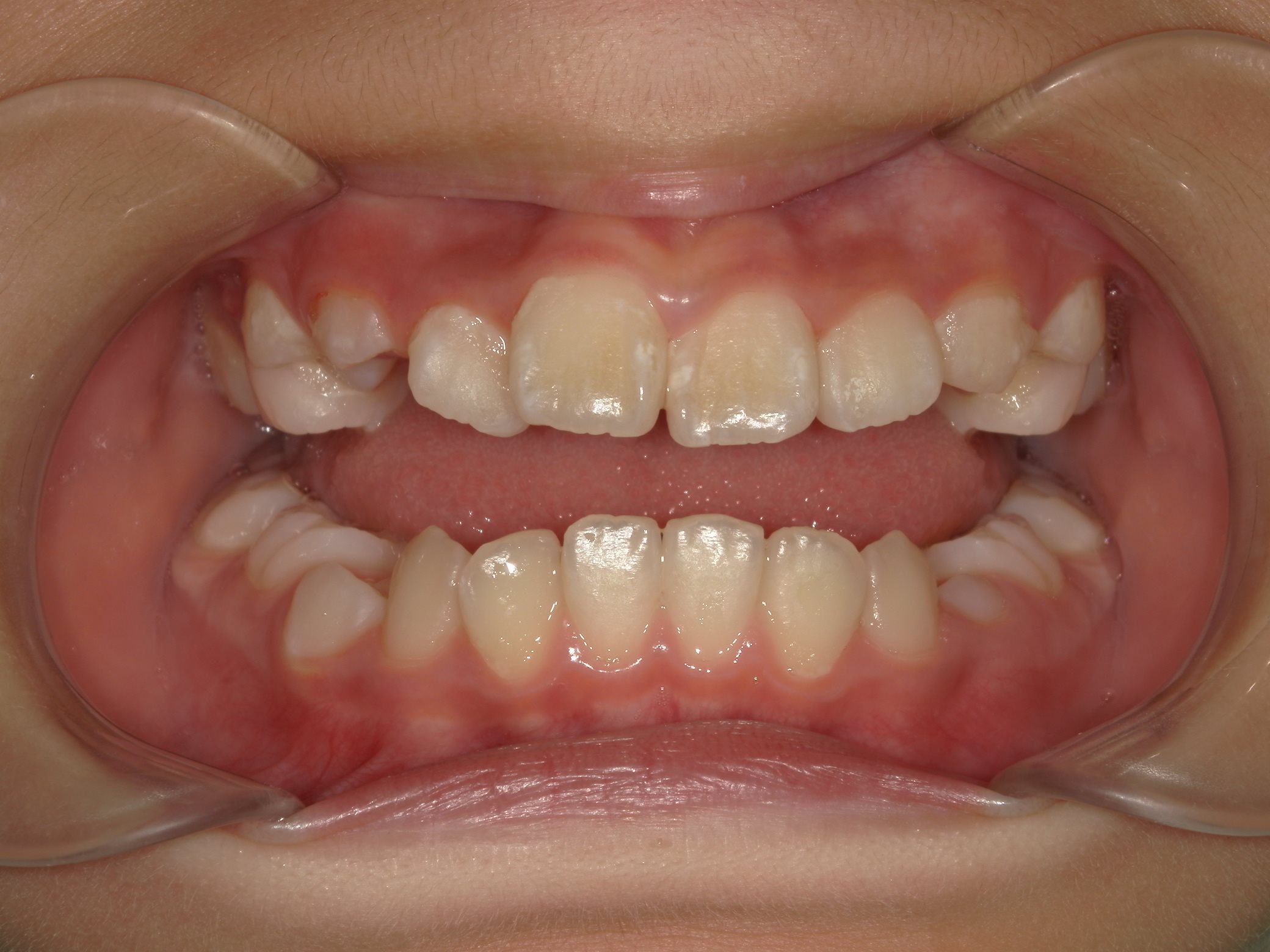 インビザラインファースト